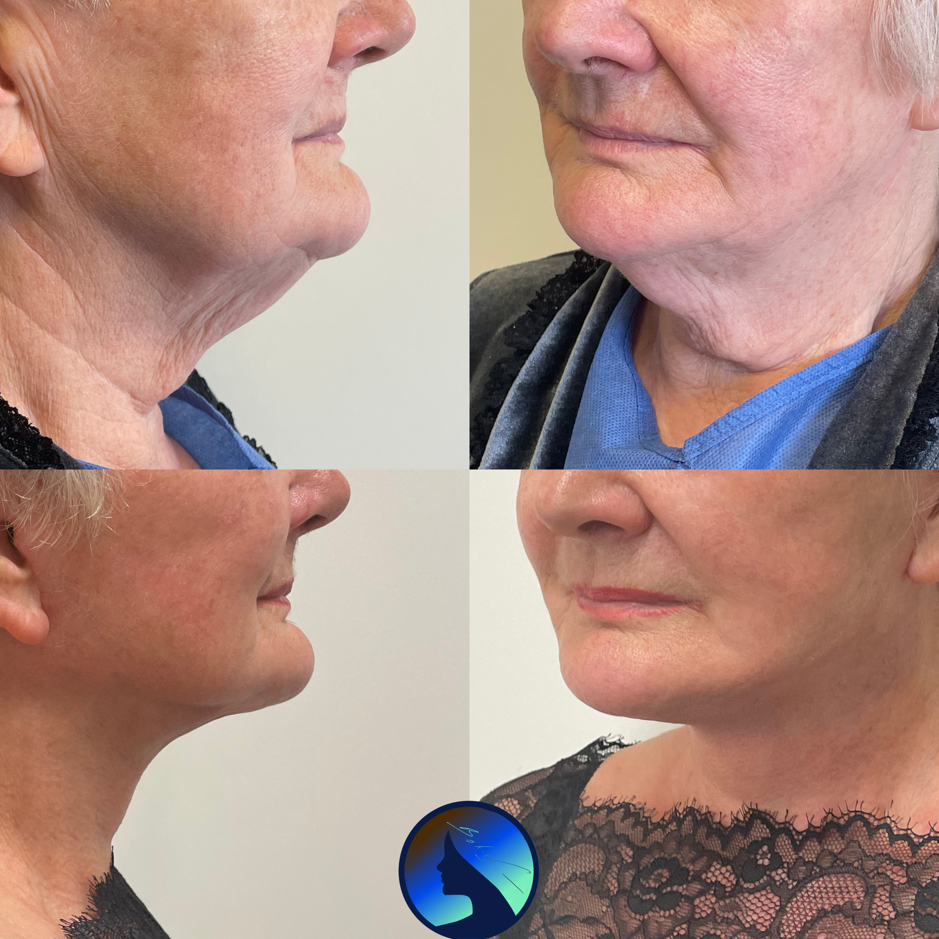 Facelift