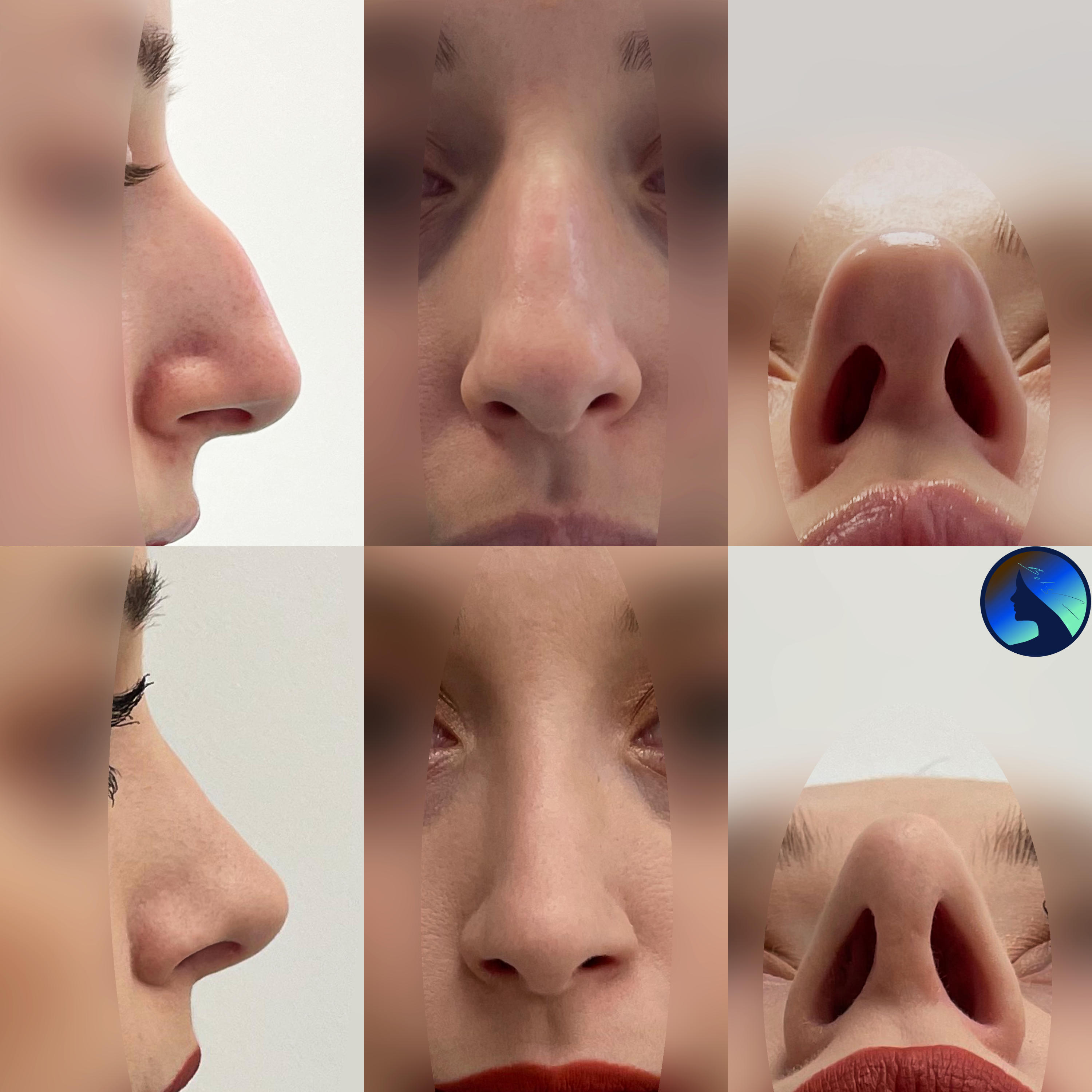A smooth rhinoplasty