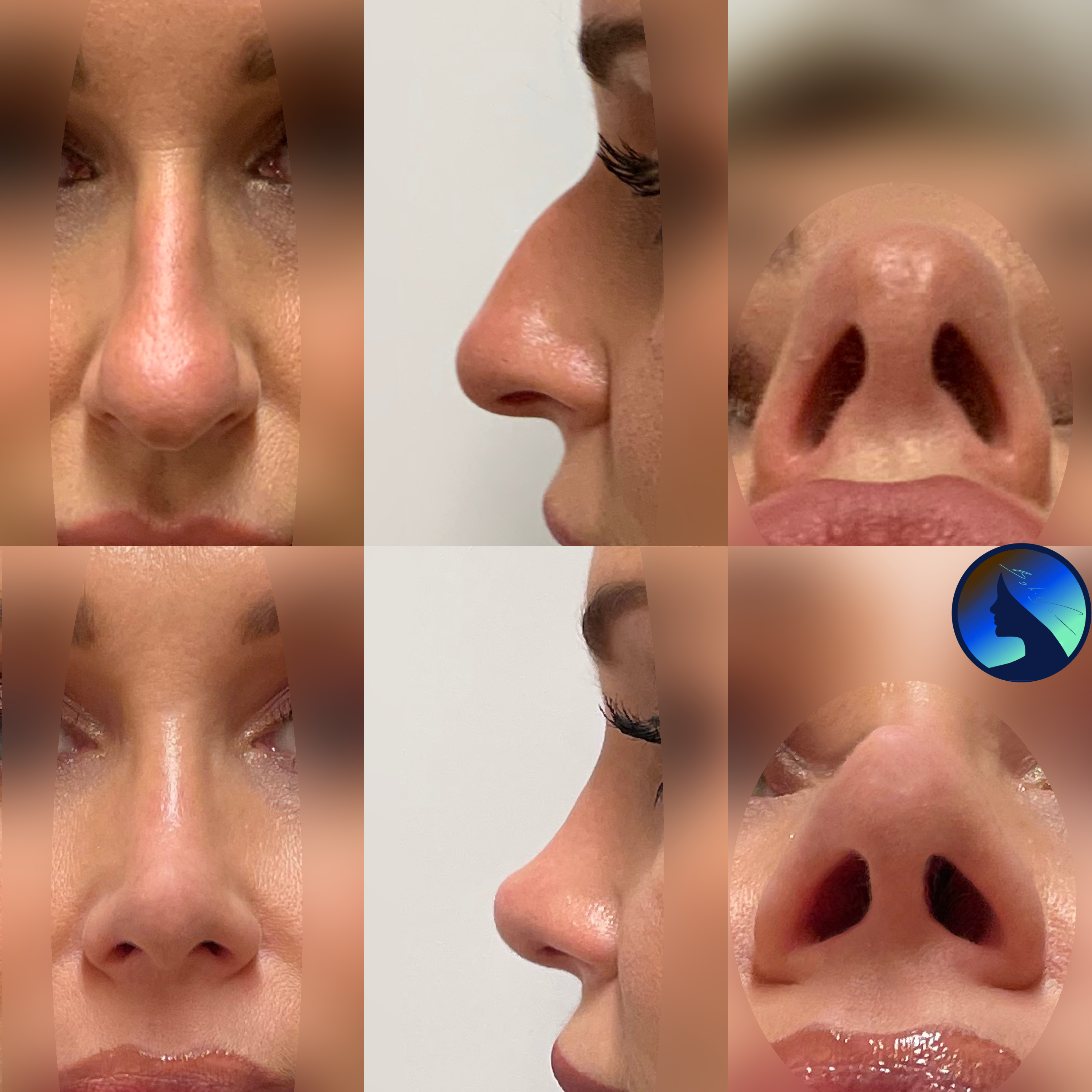 A stunning nose job