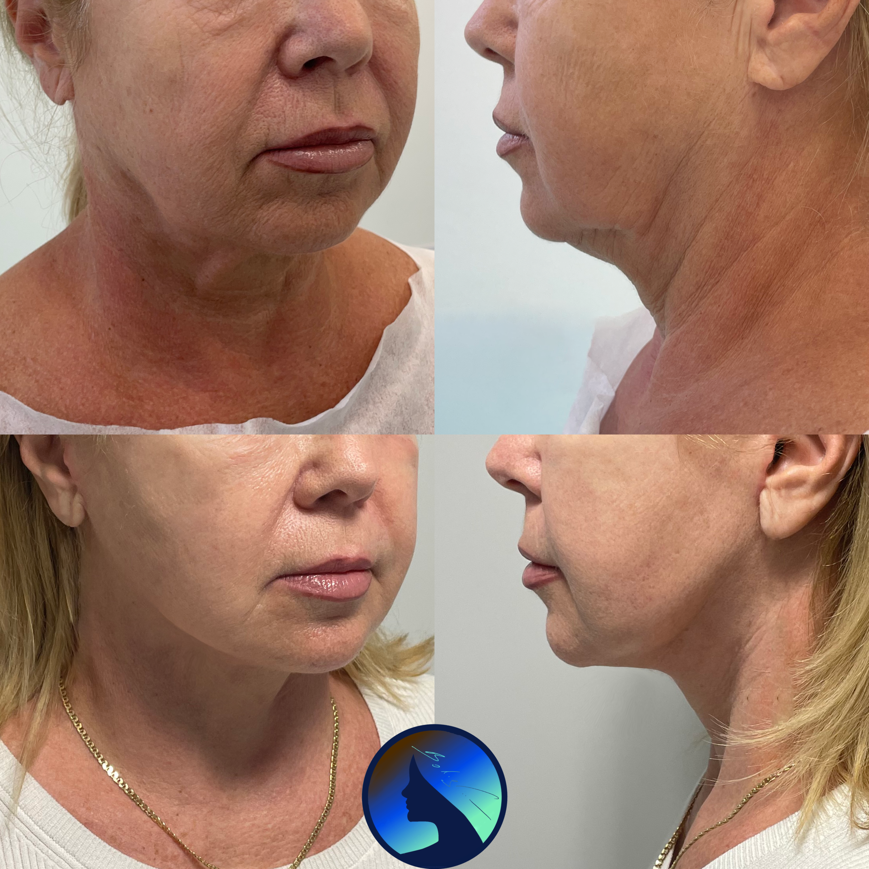 Facelift