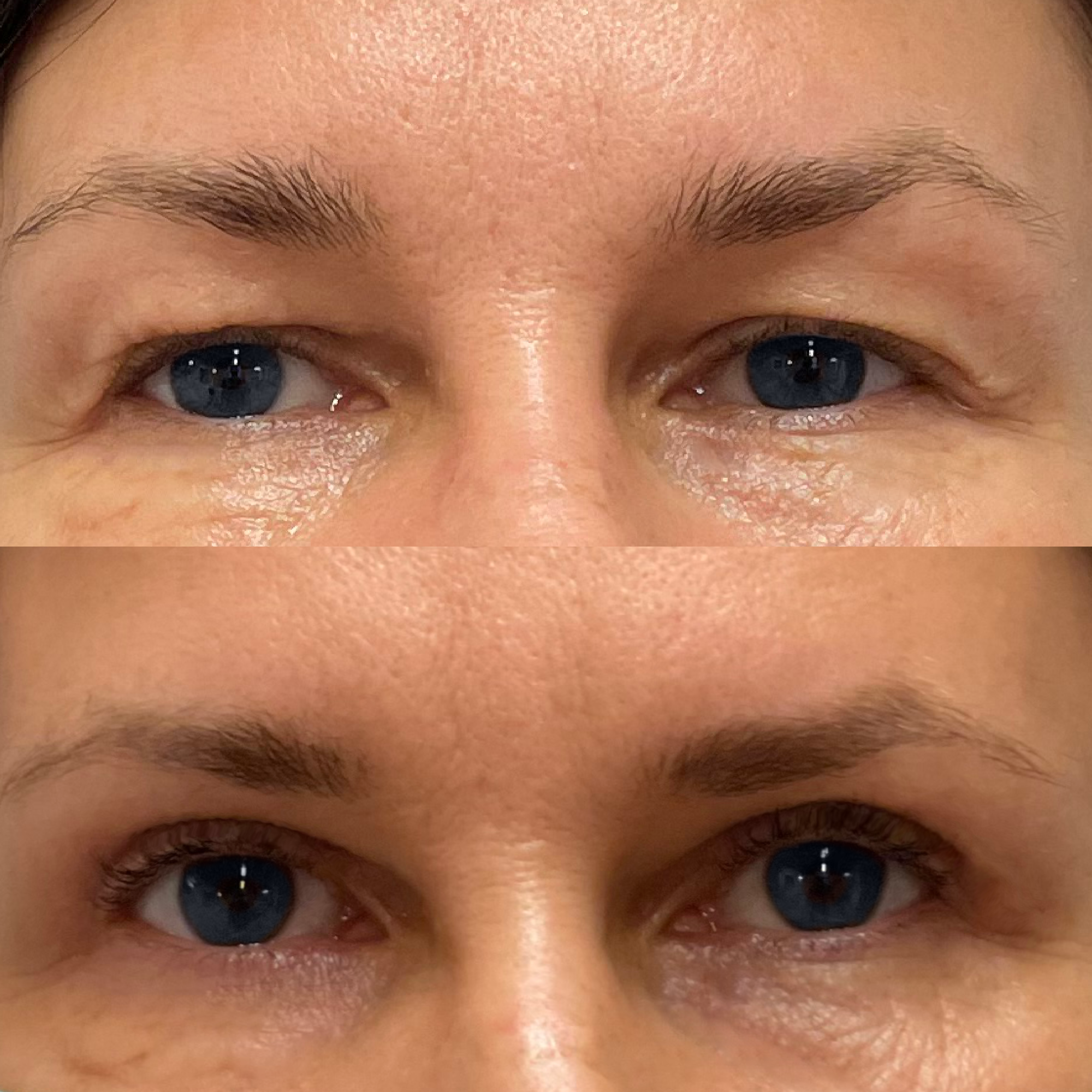 Blefaroplastyka z peksją
