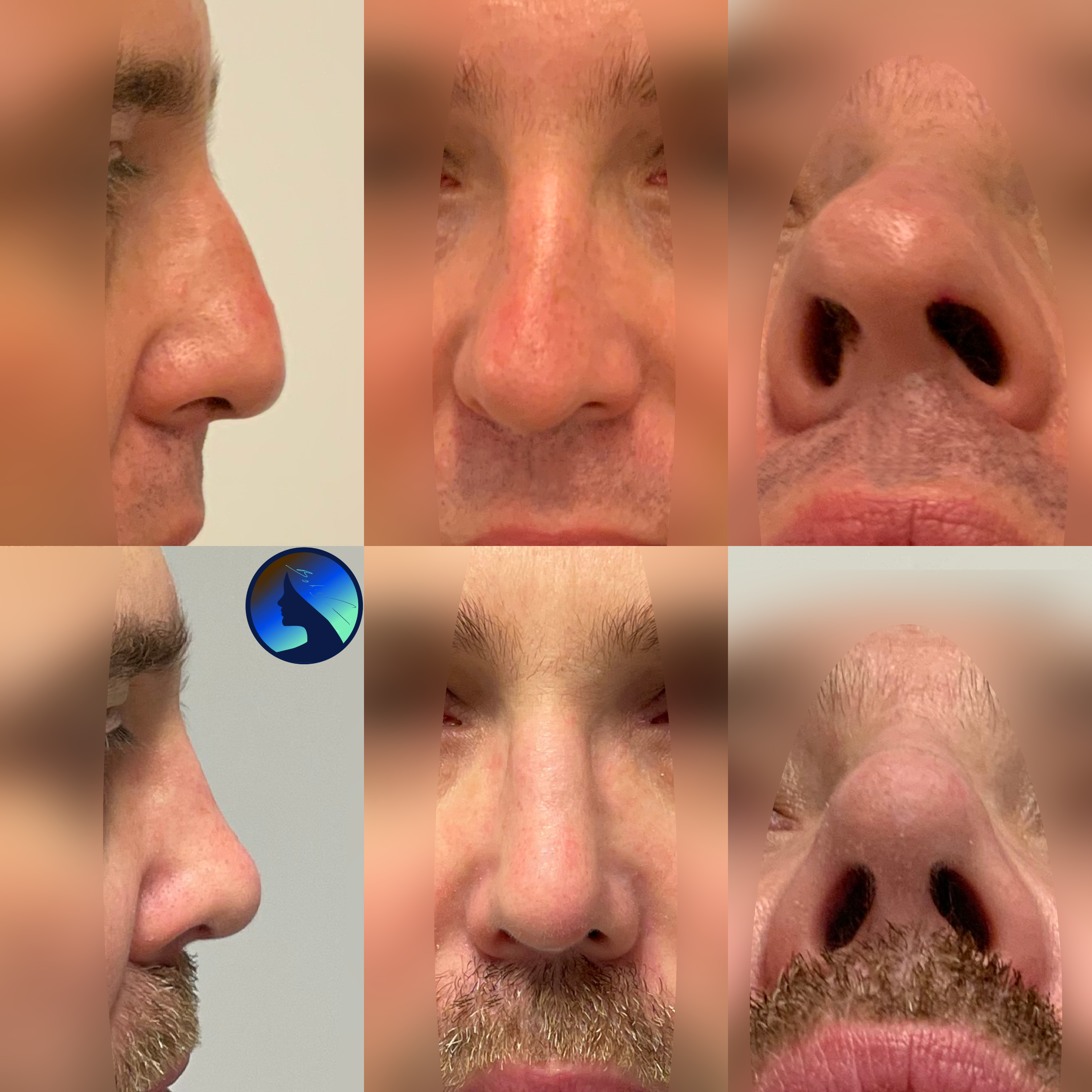 Broken nose repair