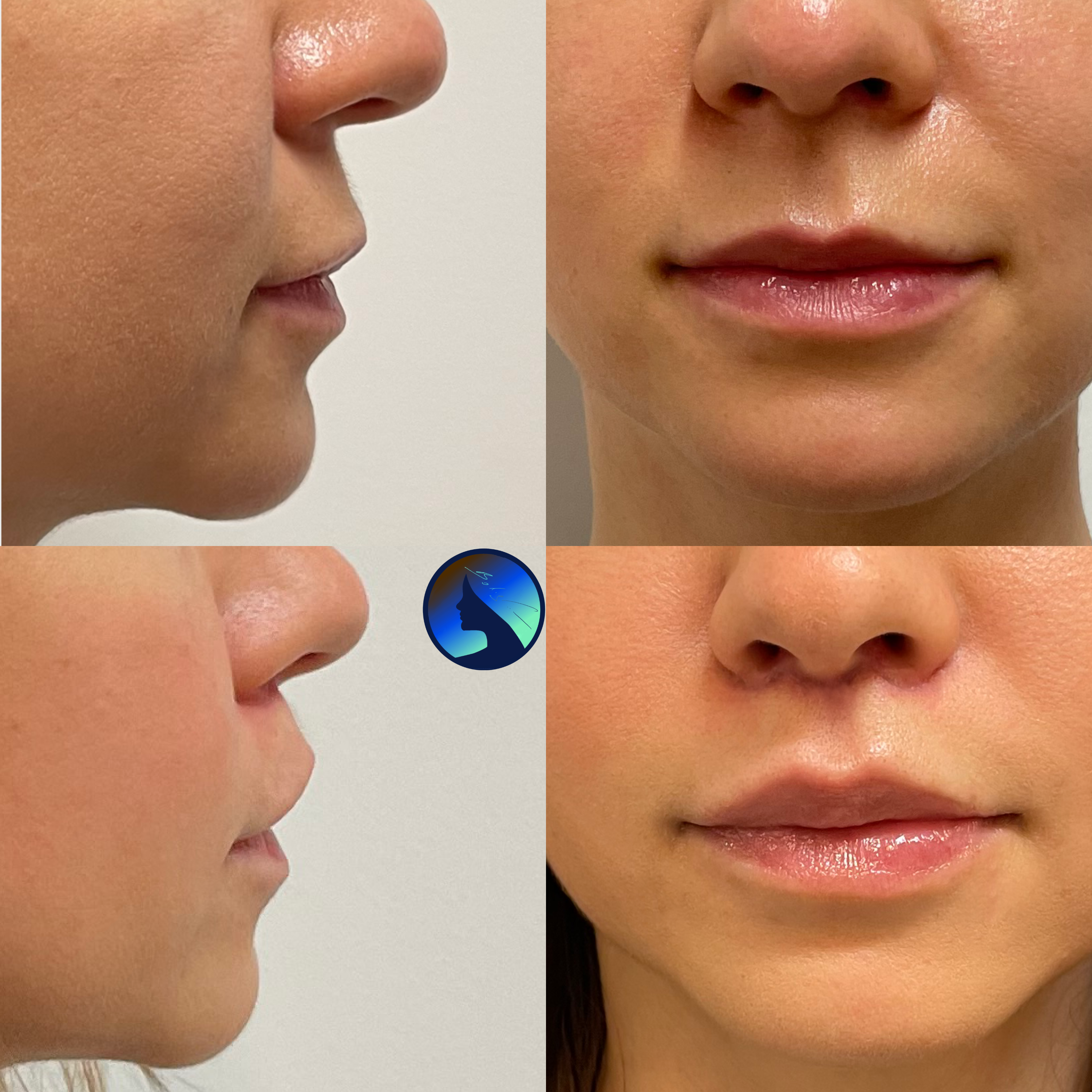 Bullhorn Lip lift