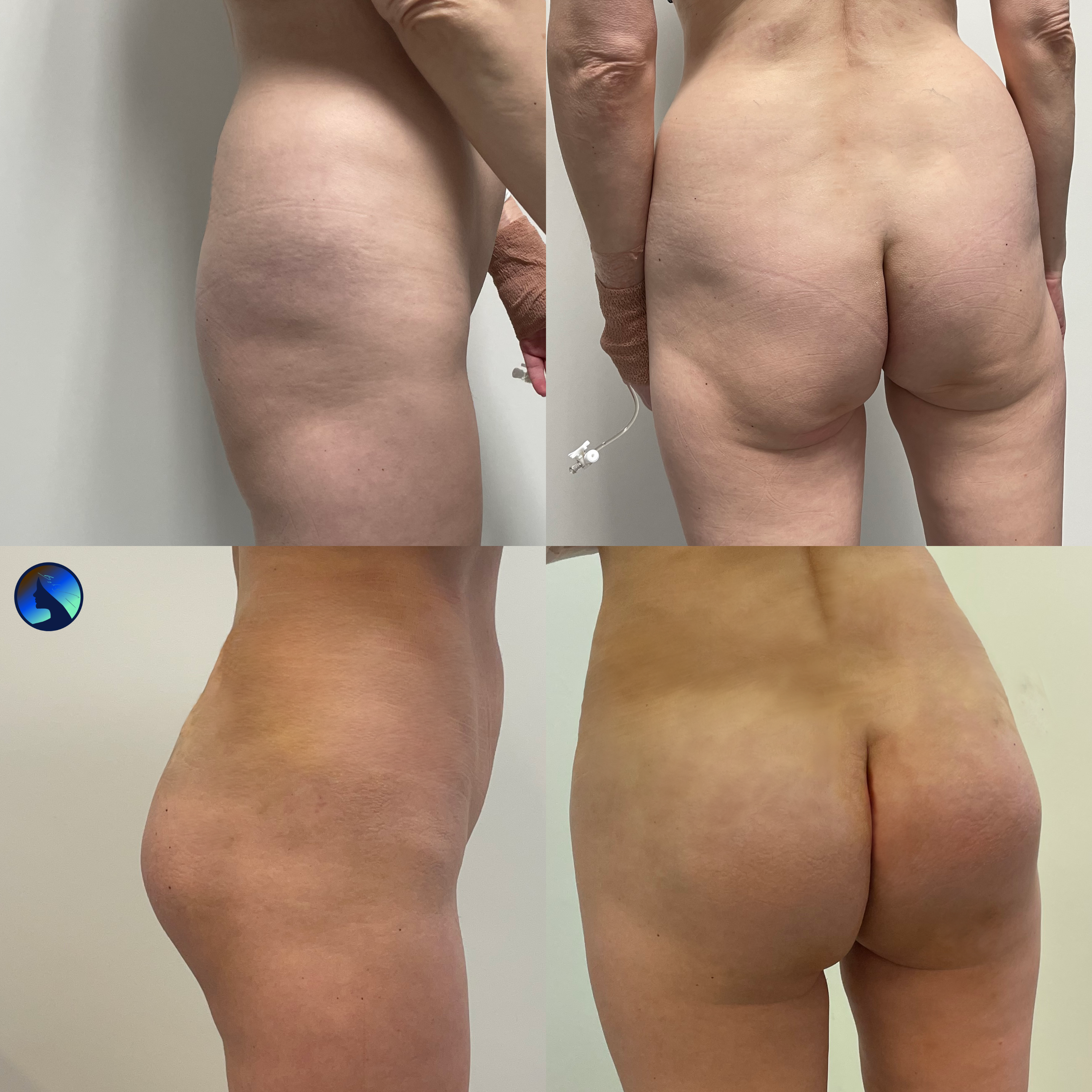 Butt Implants