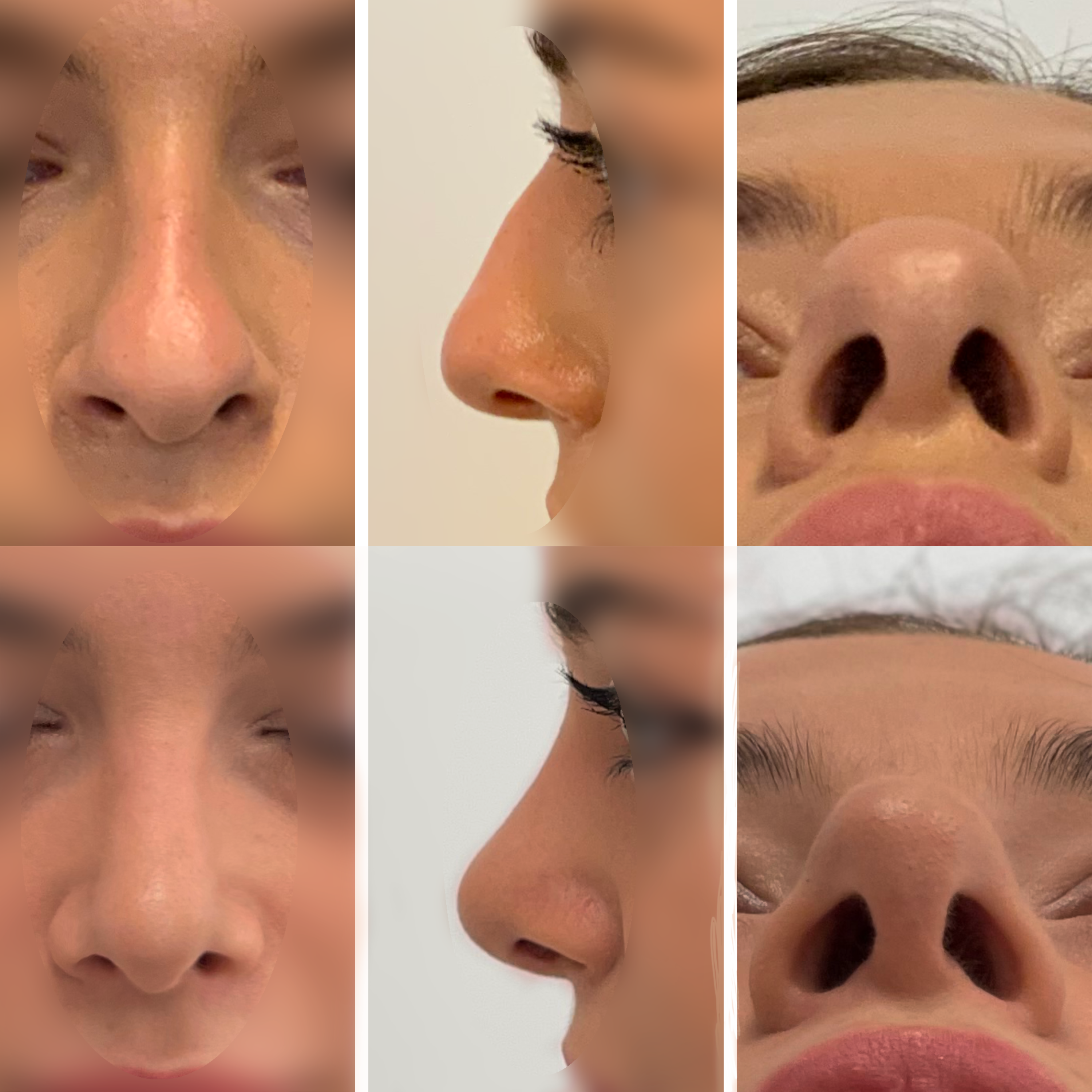 Operacja nosa