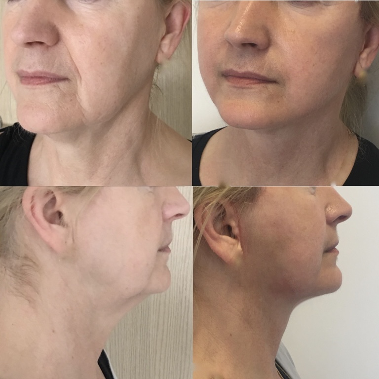 Facelift