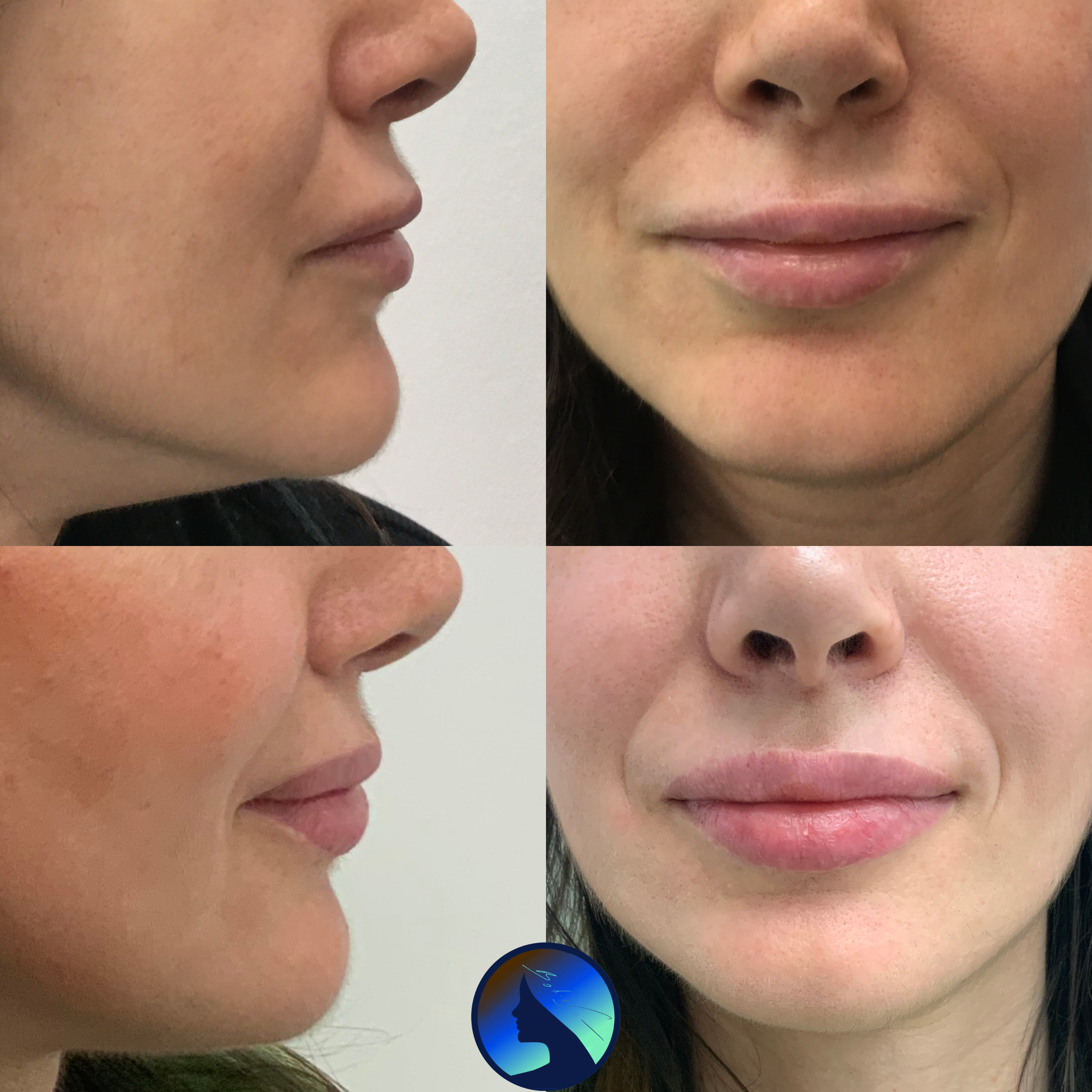 Facelift
