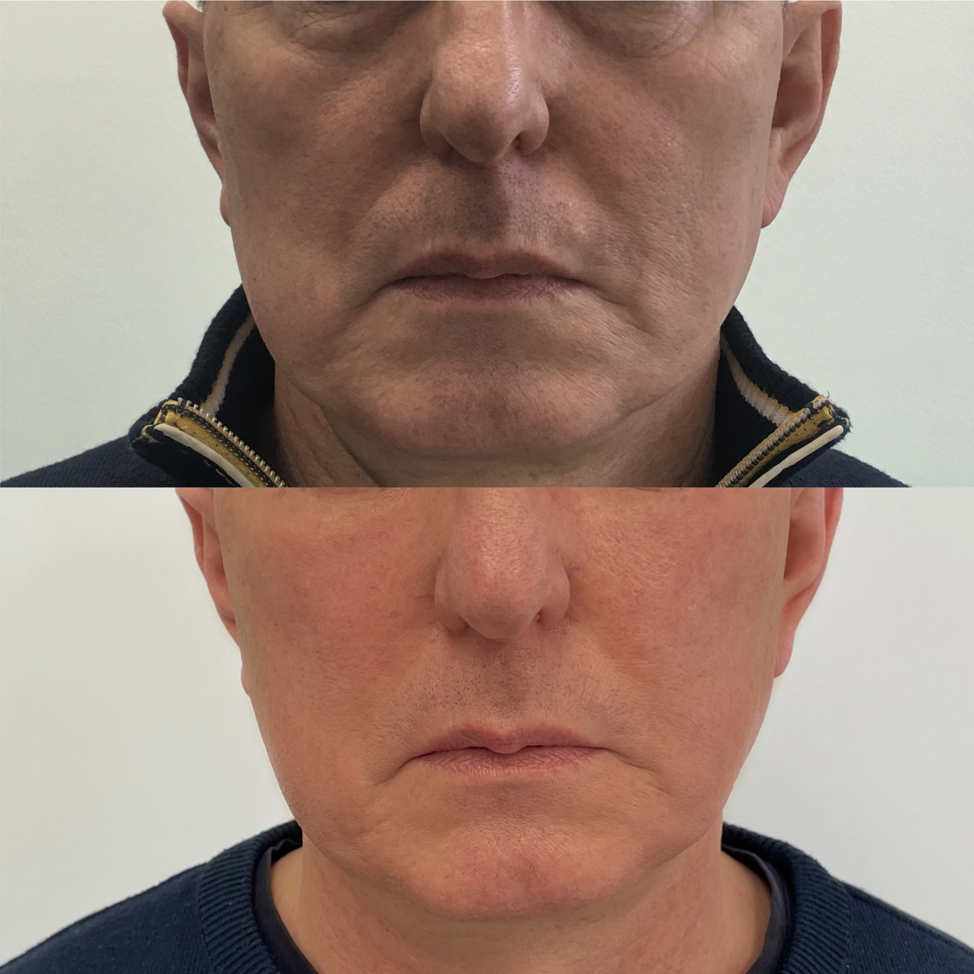 Midface Lift
