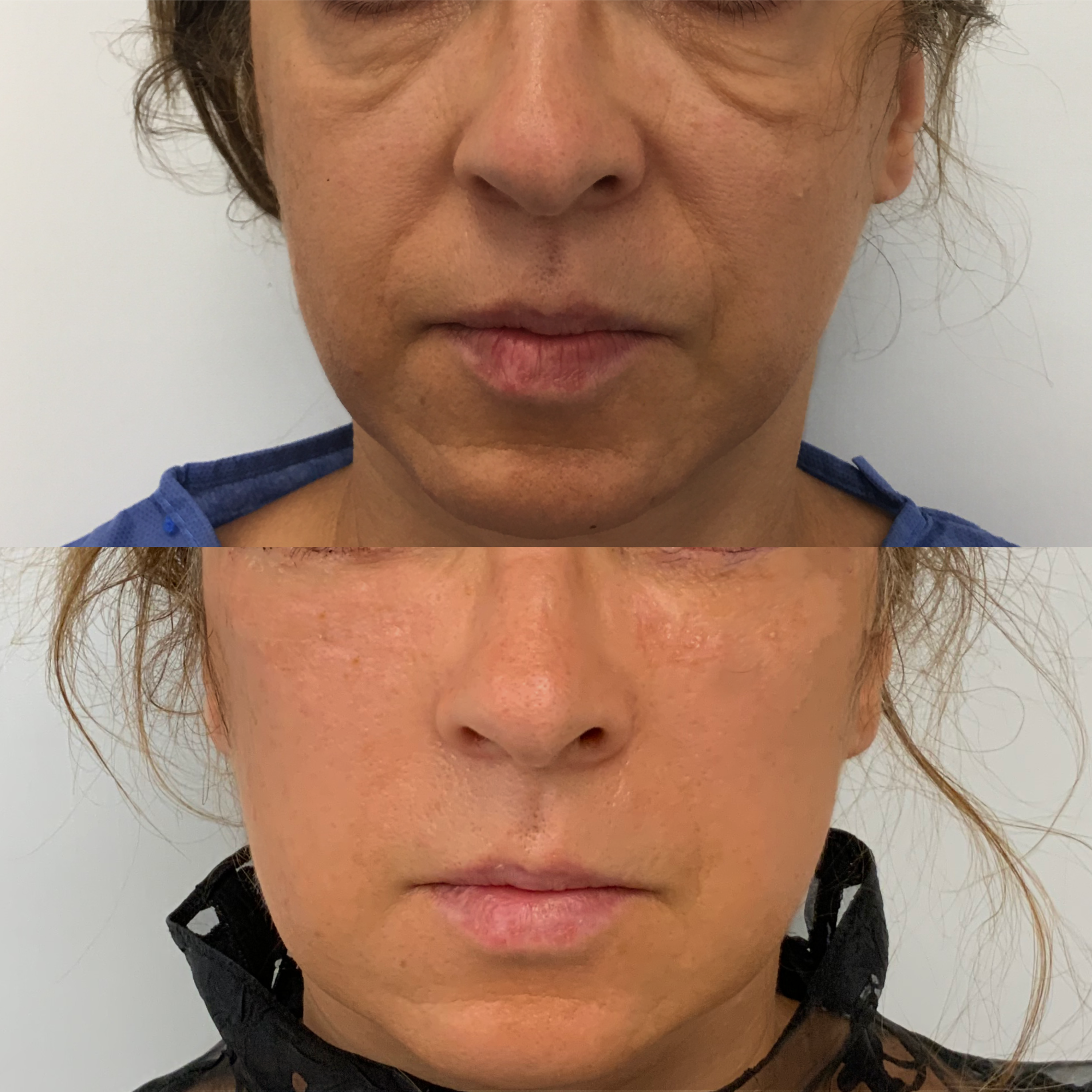 Midface-Lift