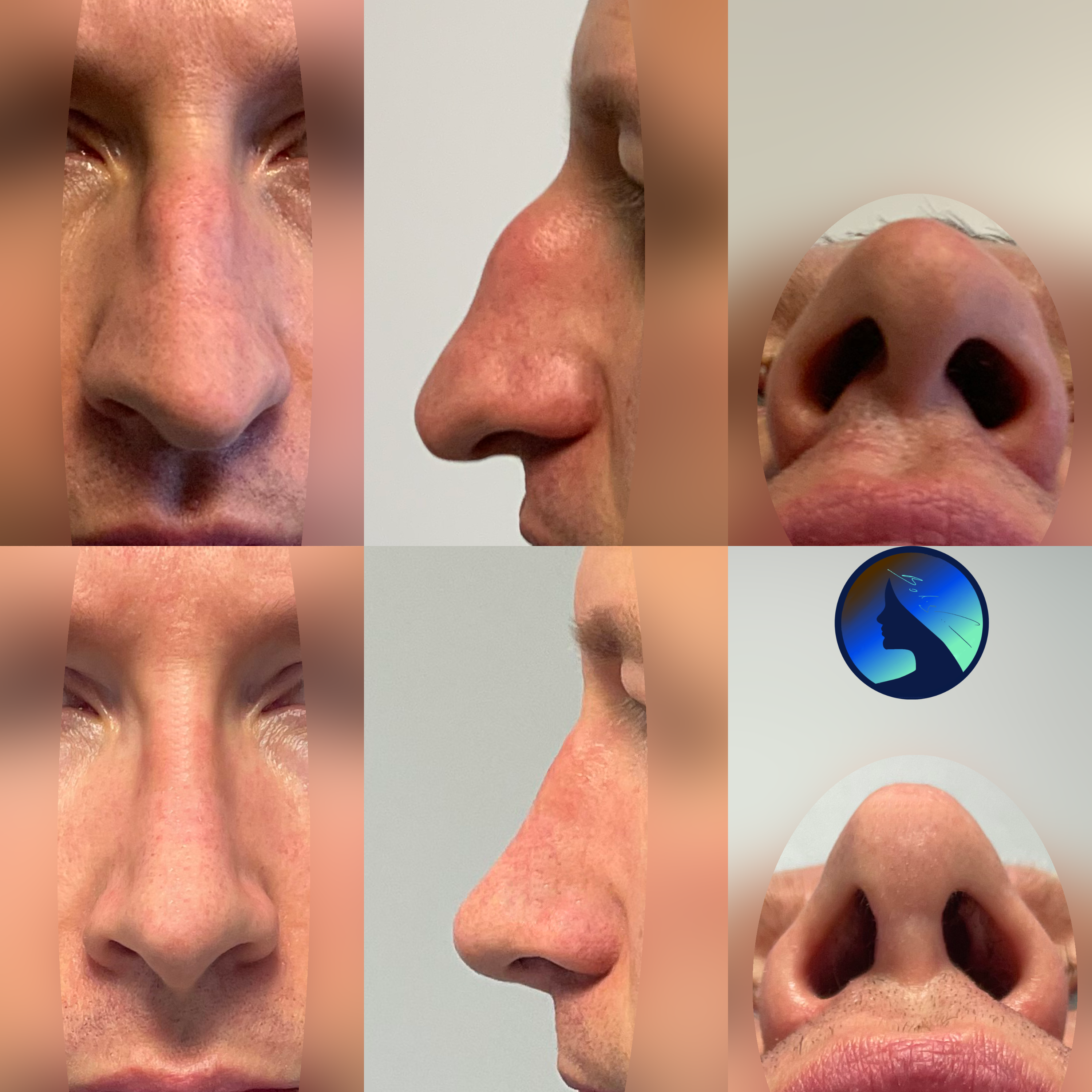 Nose Job in Man