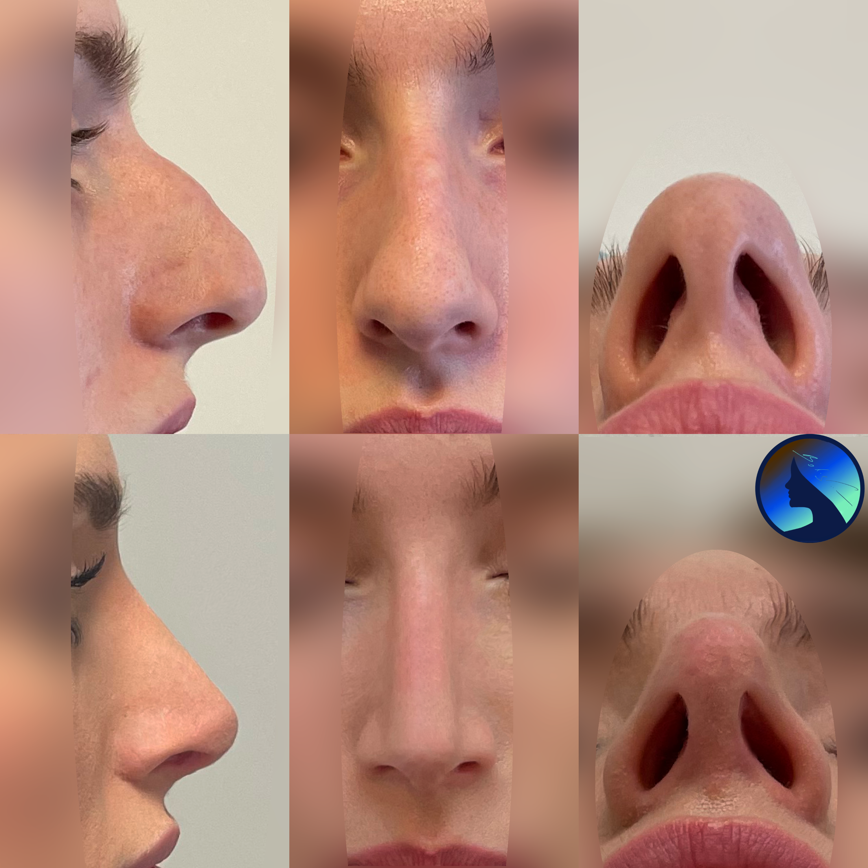Nose job before and after