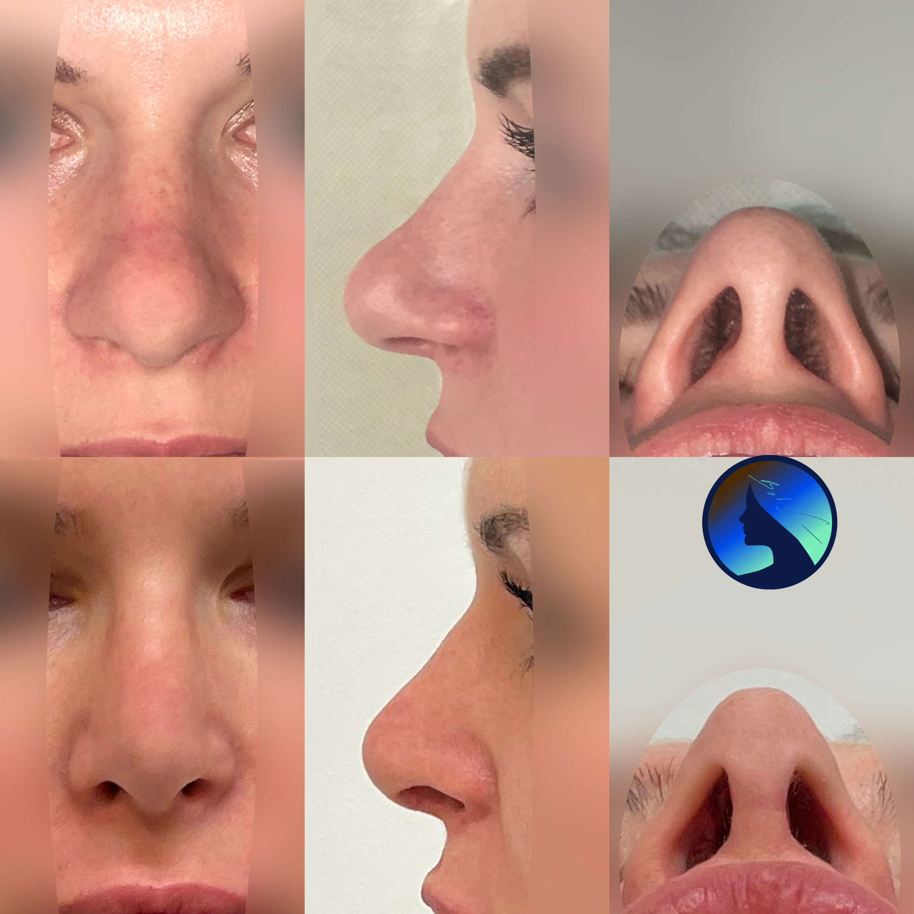 Wtórna korekta nosa