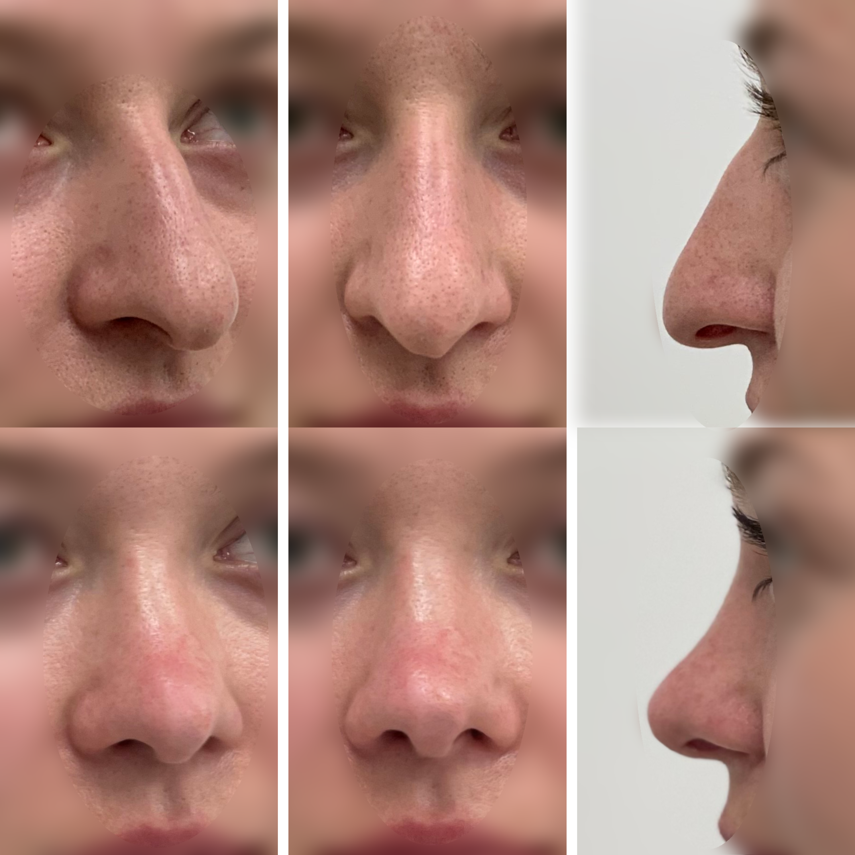 Septorhinoplasty