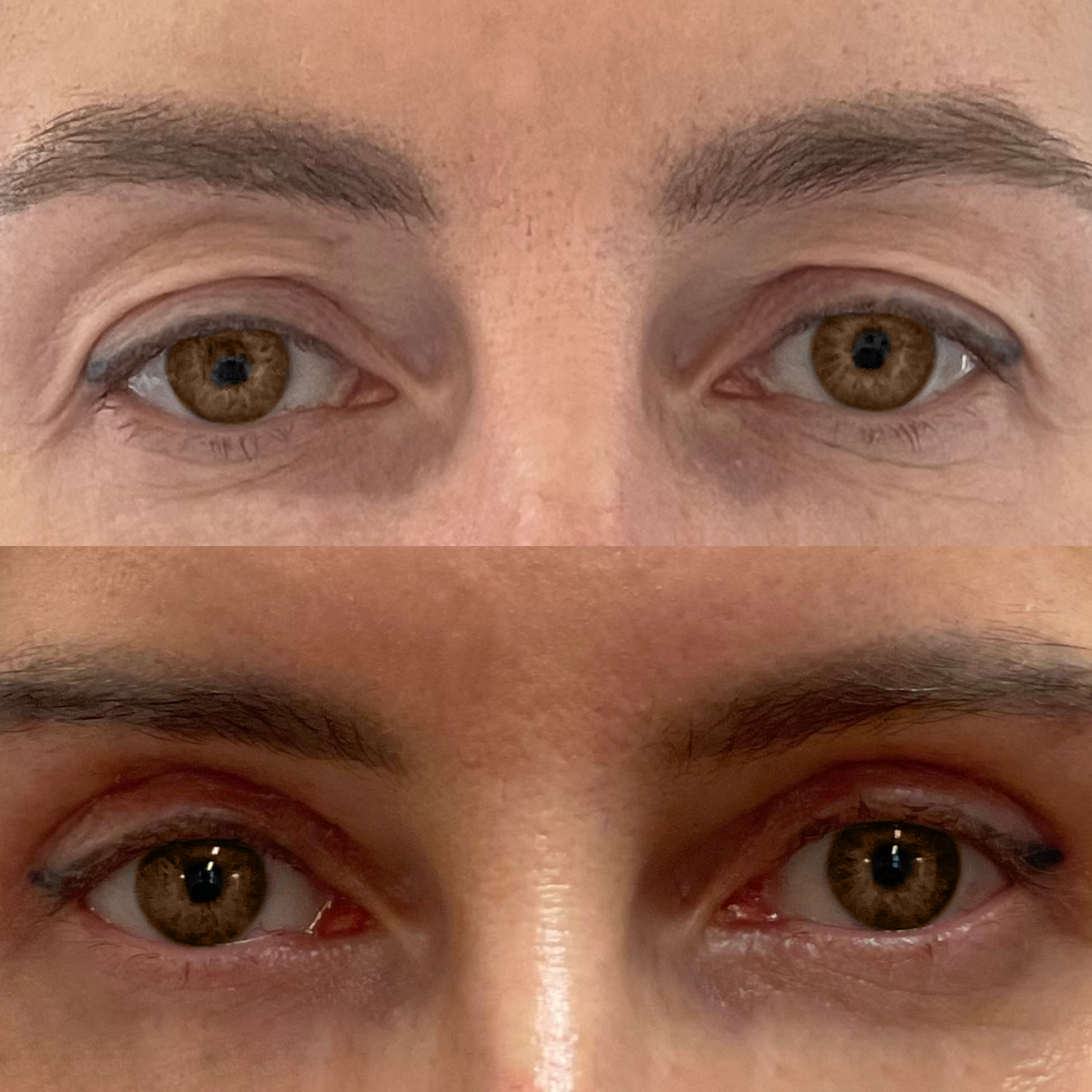 upper blepharoplasty