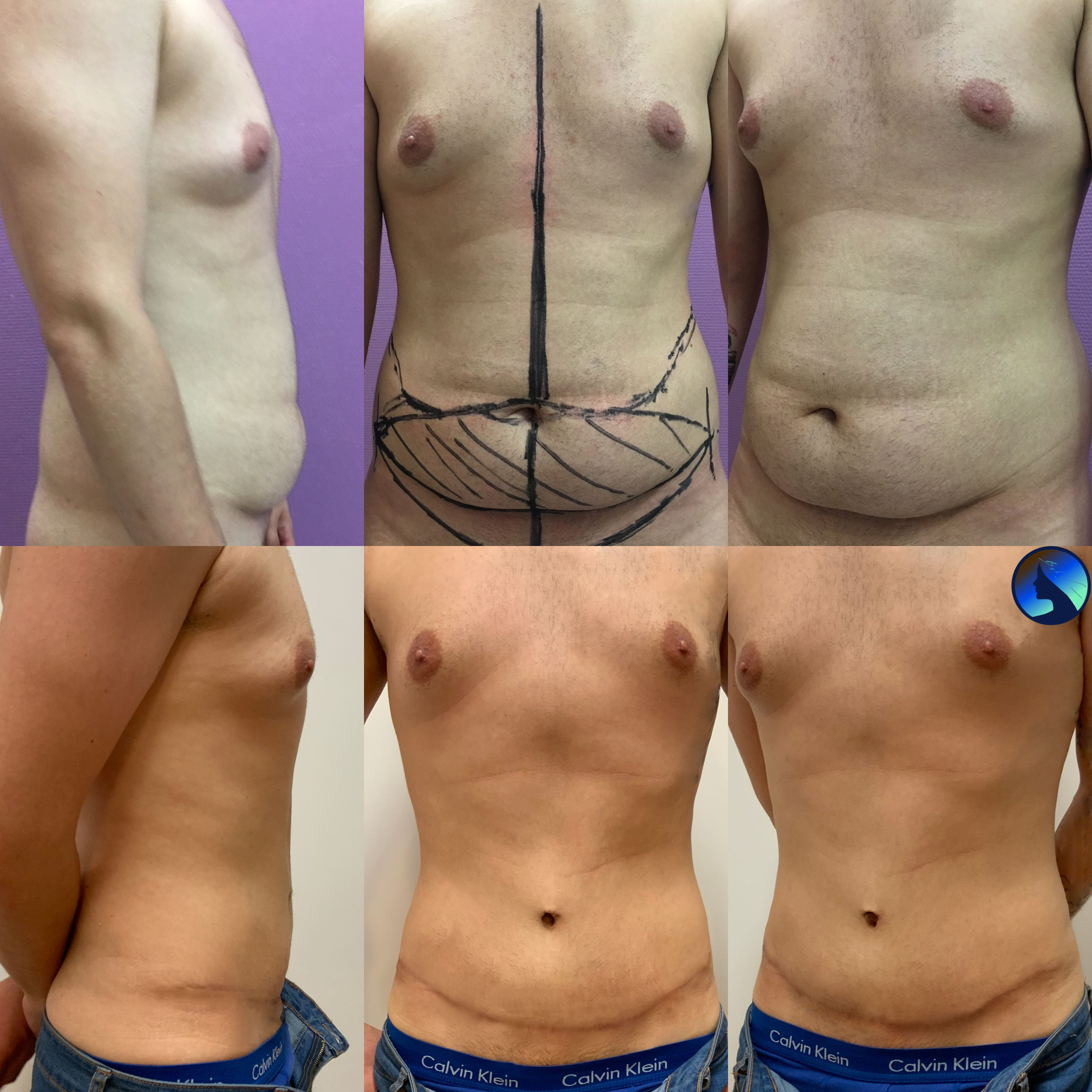 a fresh abdominoplasty