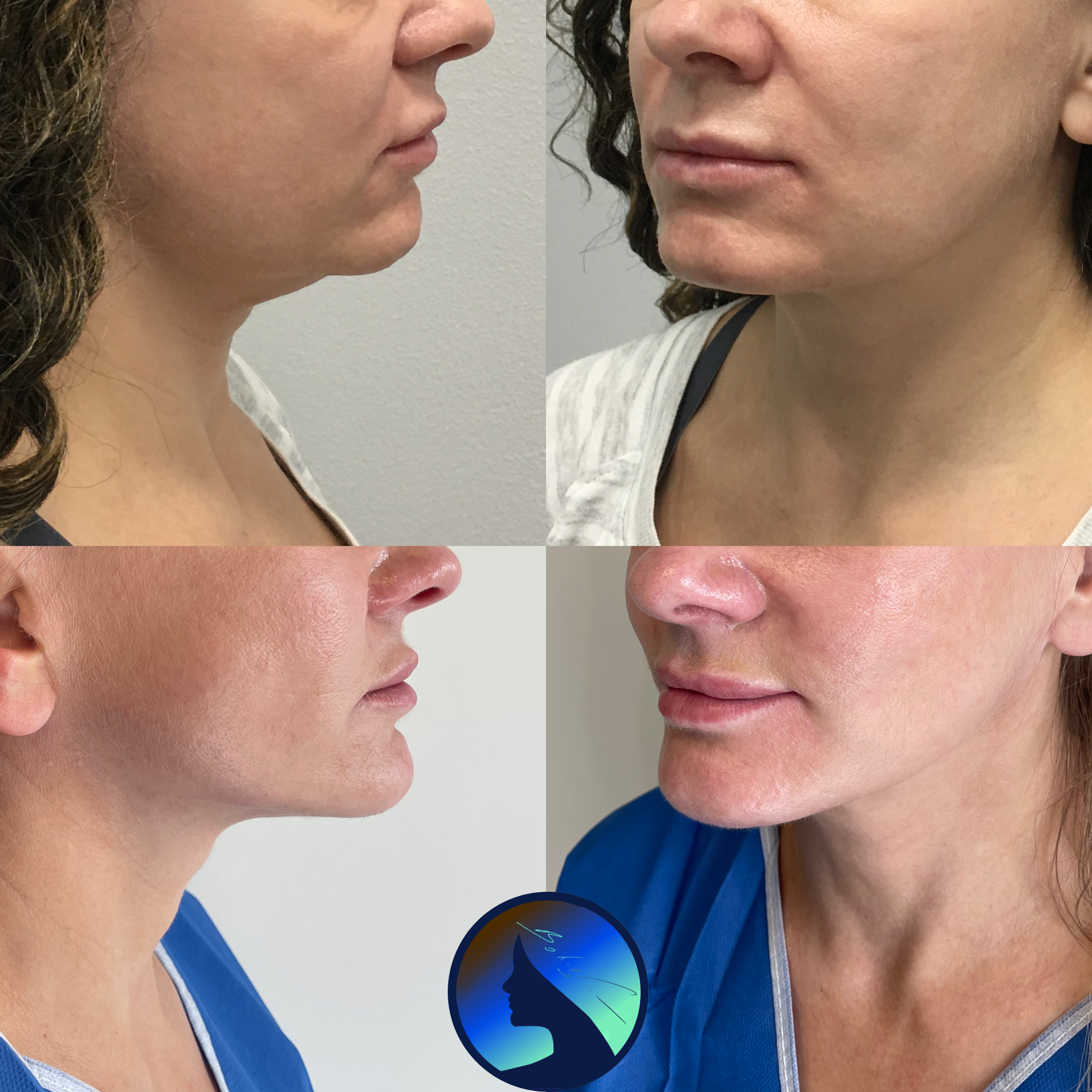 Facelift