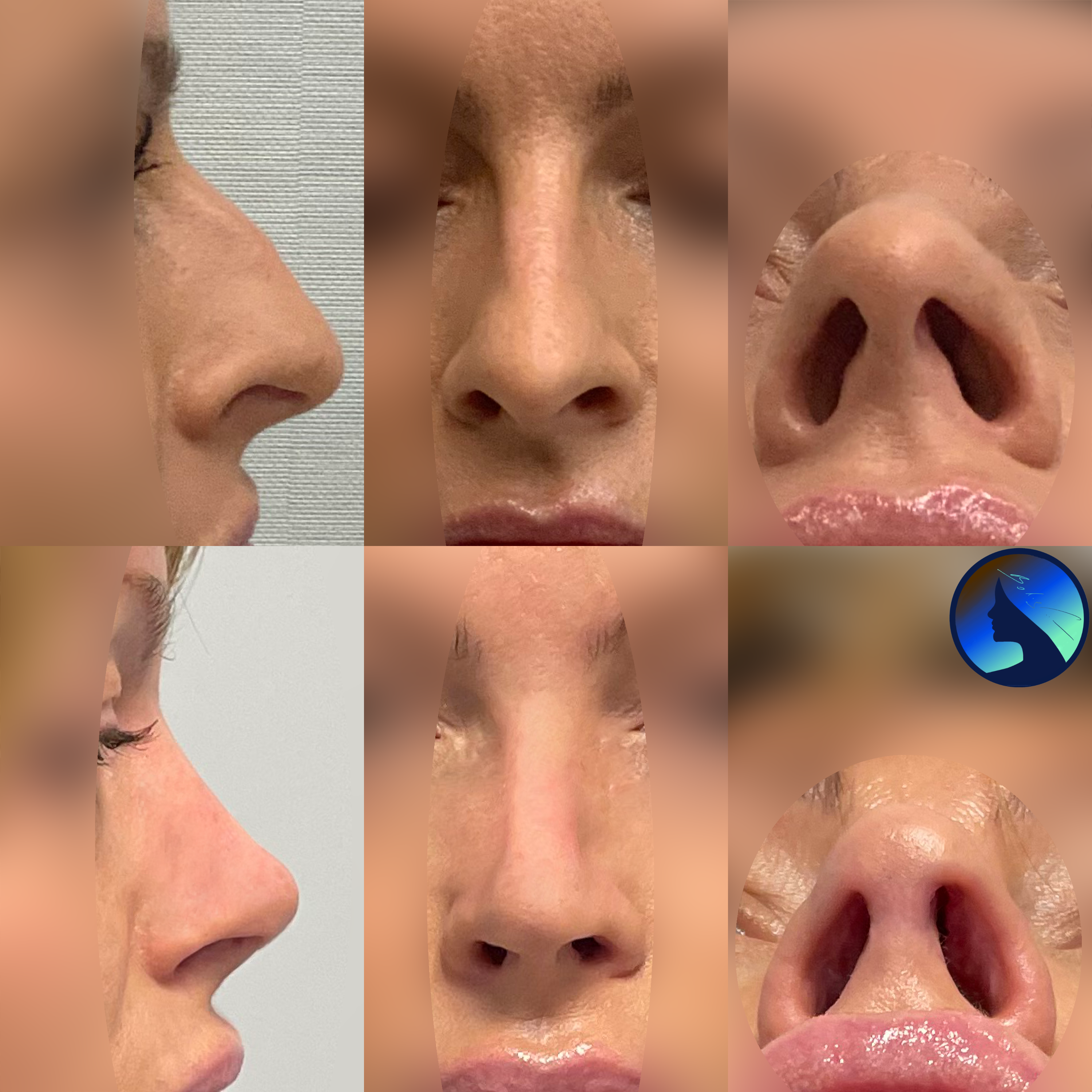 difficult Barbie Nose