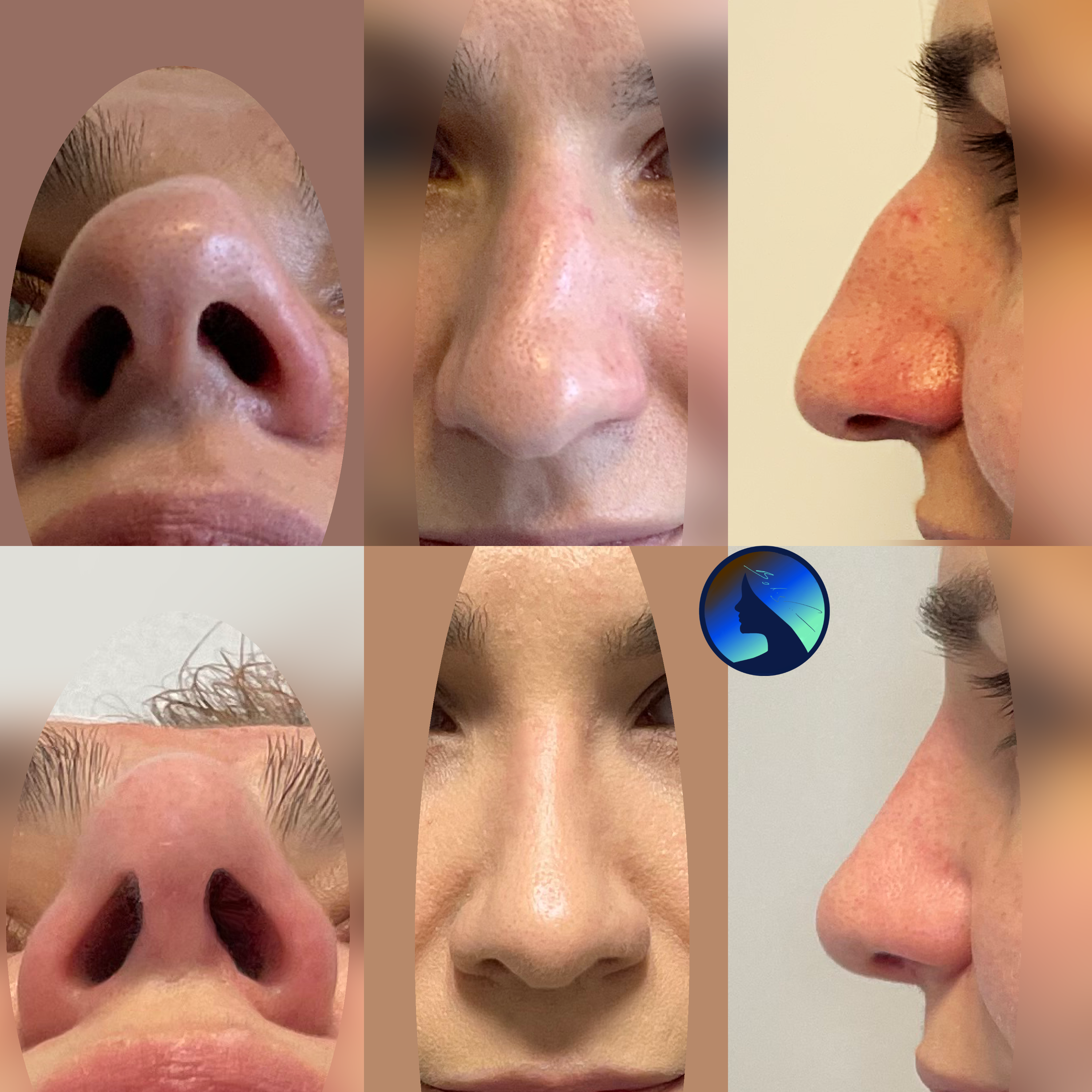 nose straightening