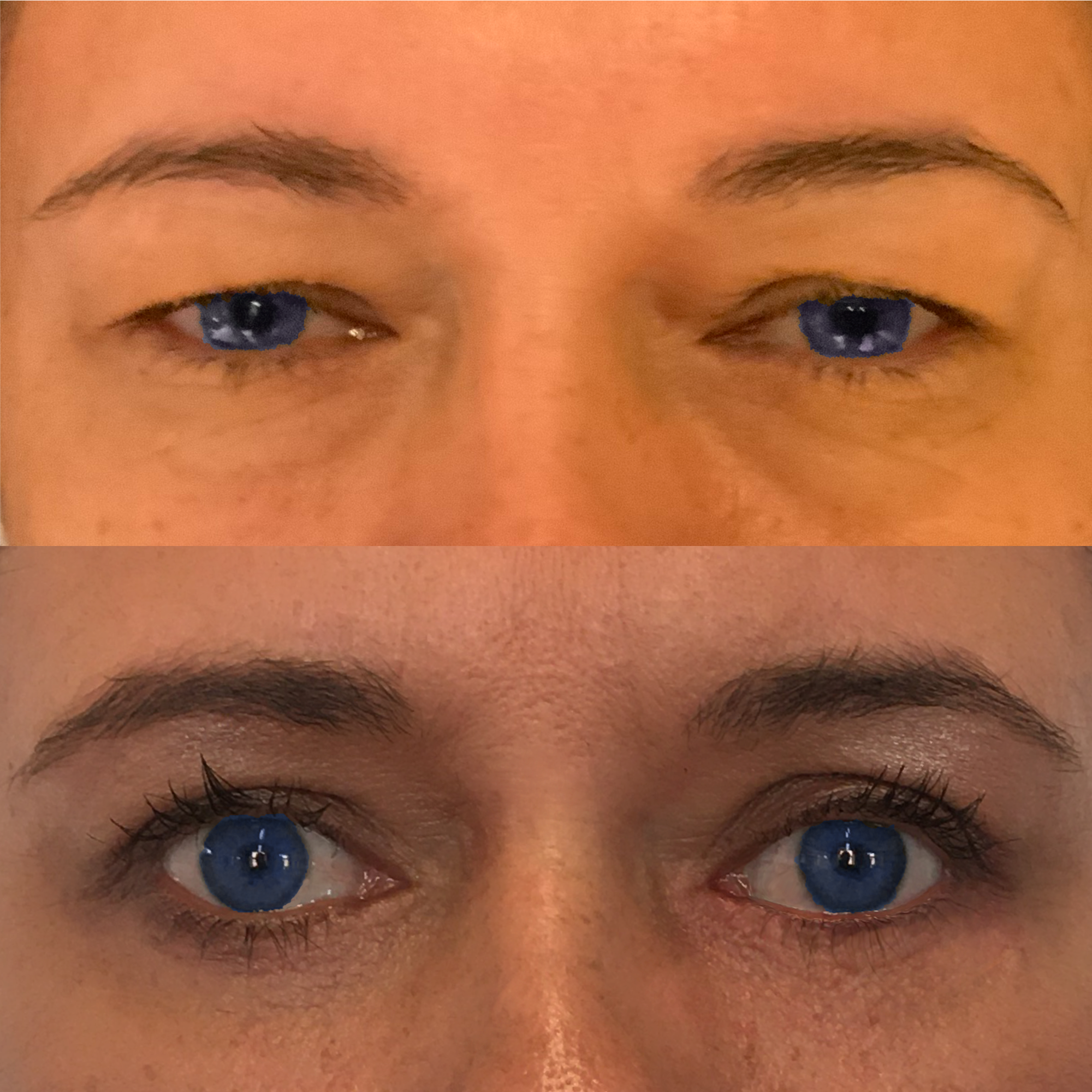 Facelift