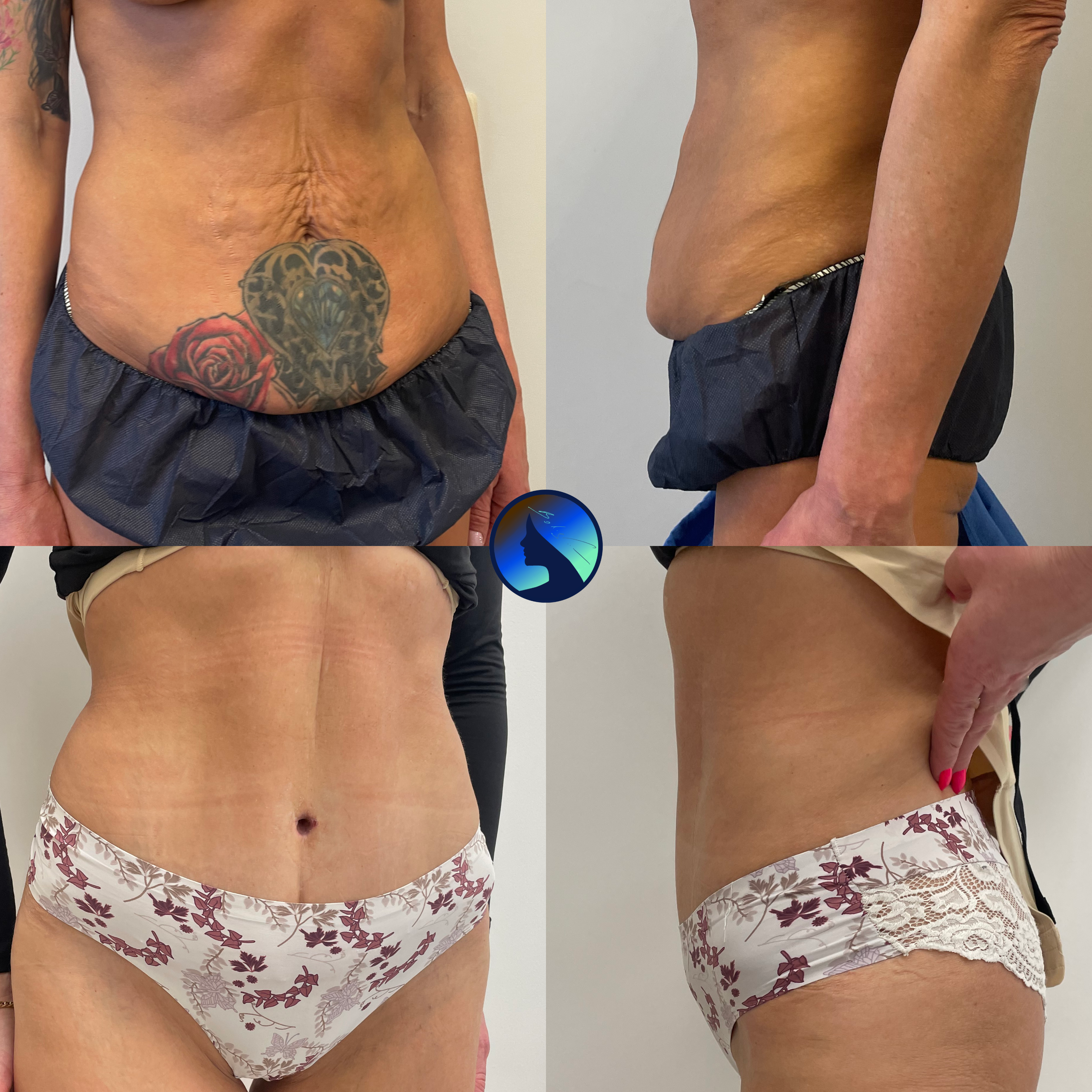 tatoo removal