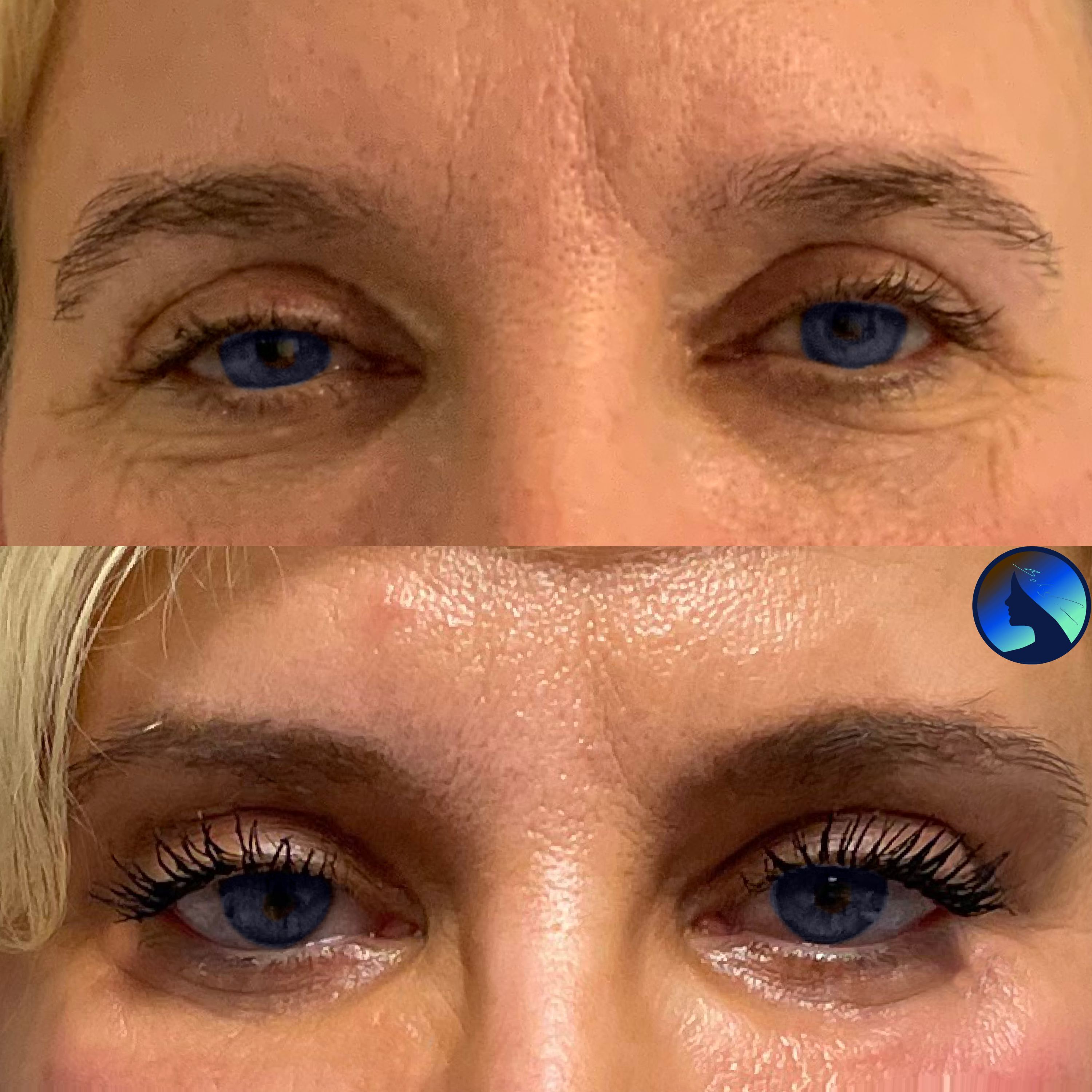 Facelift