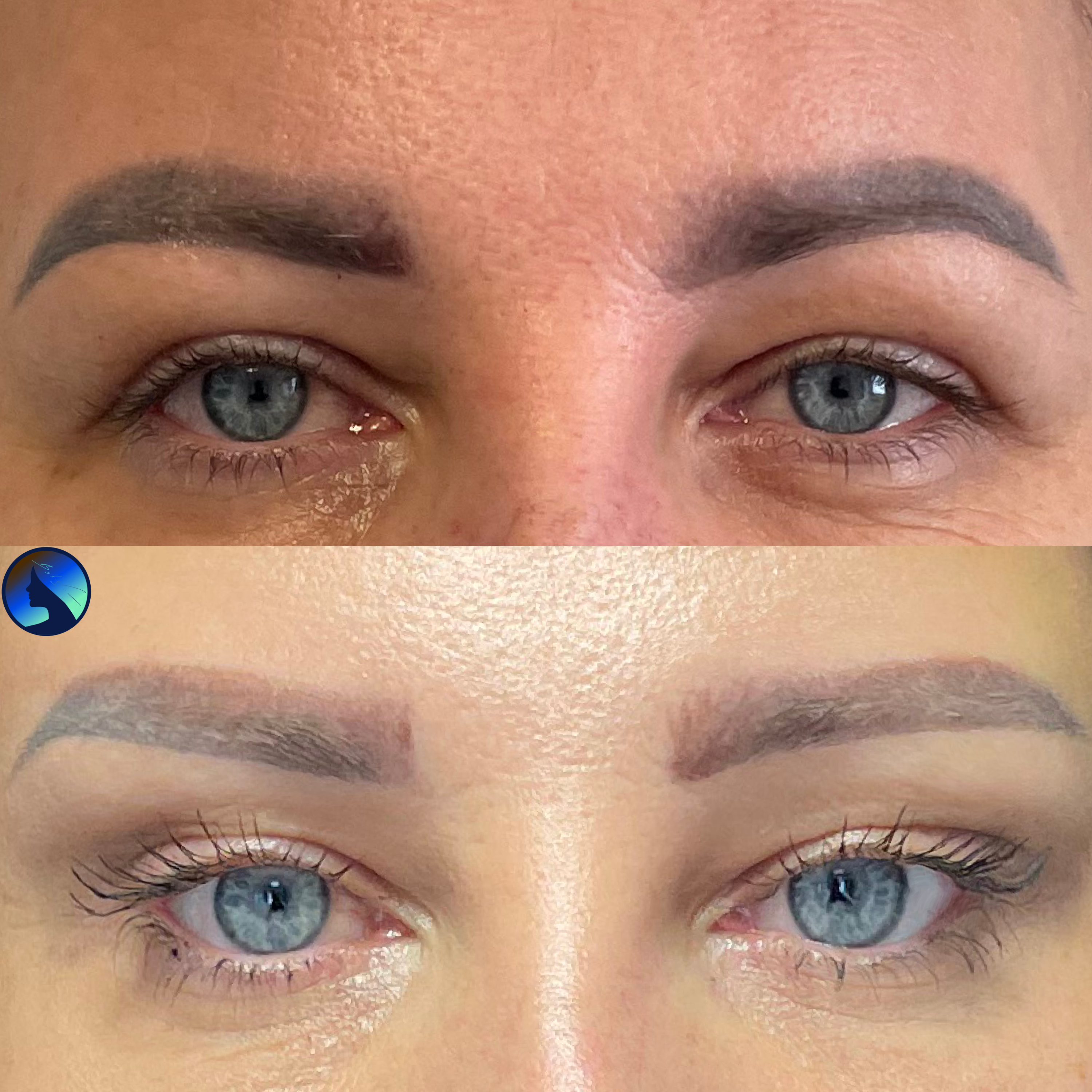 Facelift