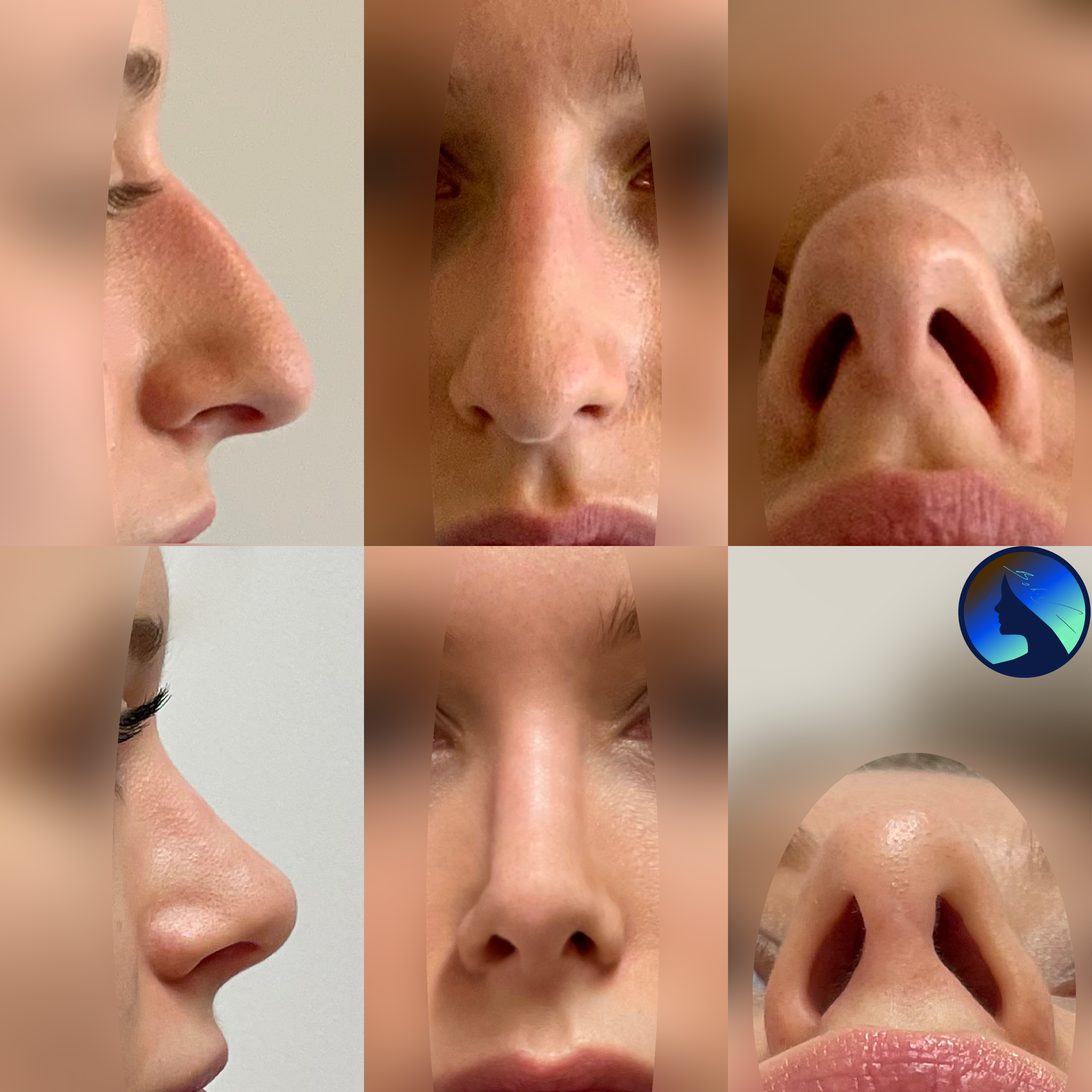 the Barbie nose