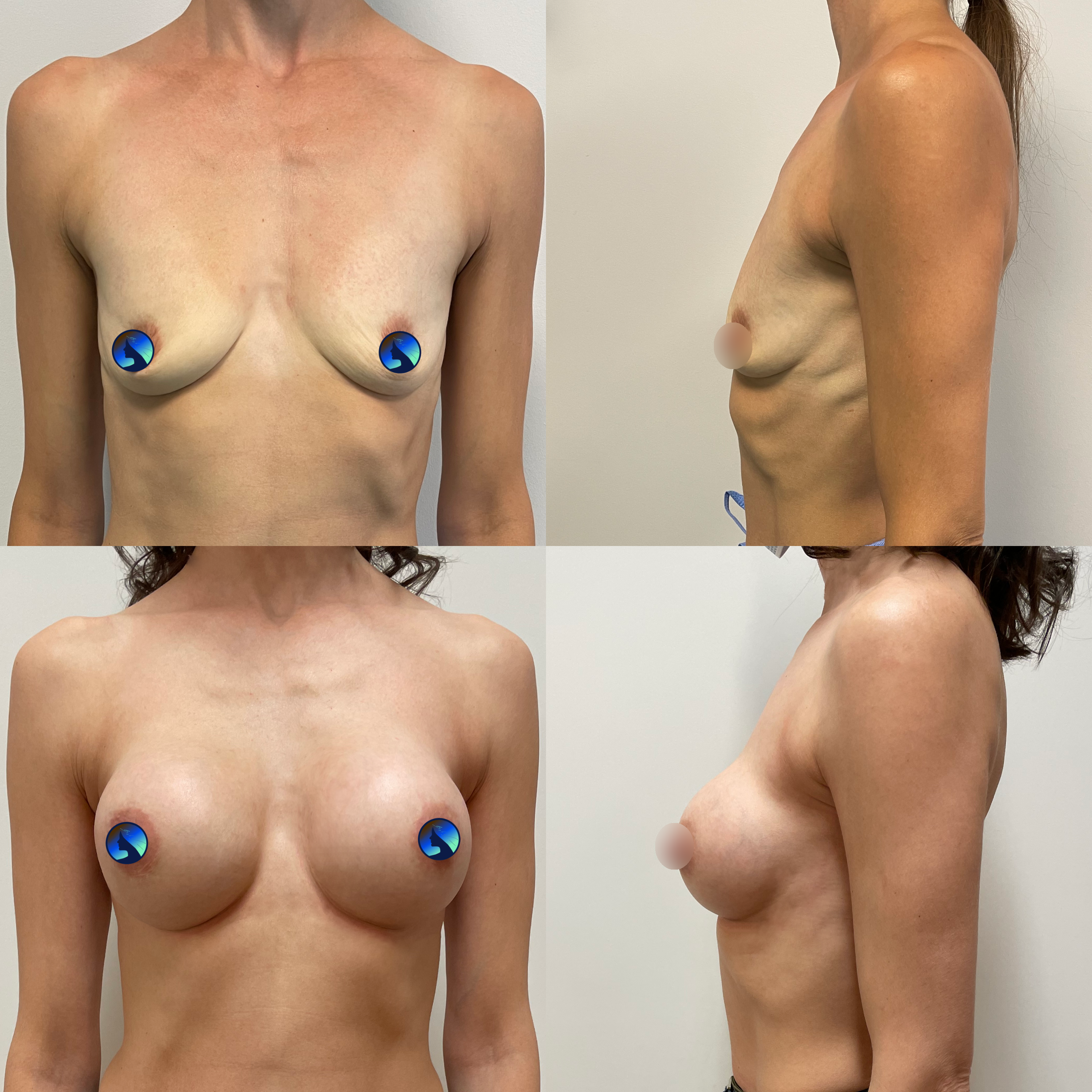 Amazing endoscopic breast augmentation