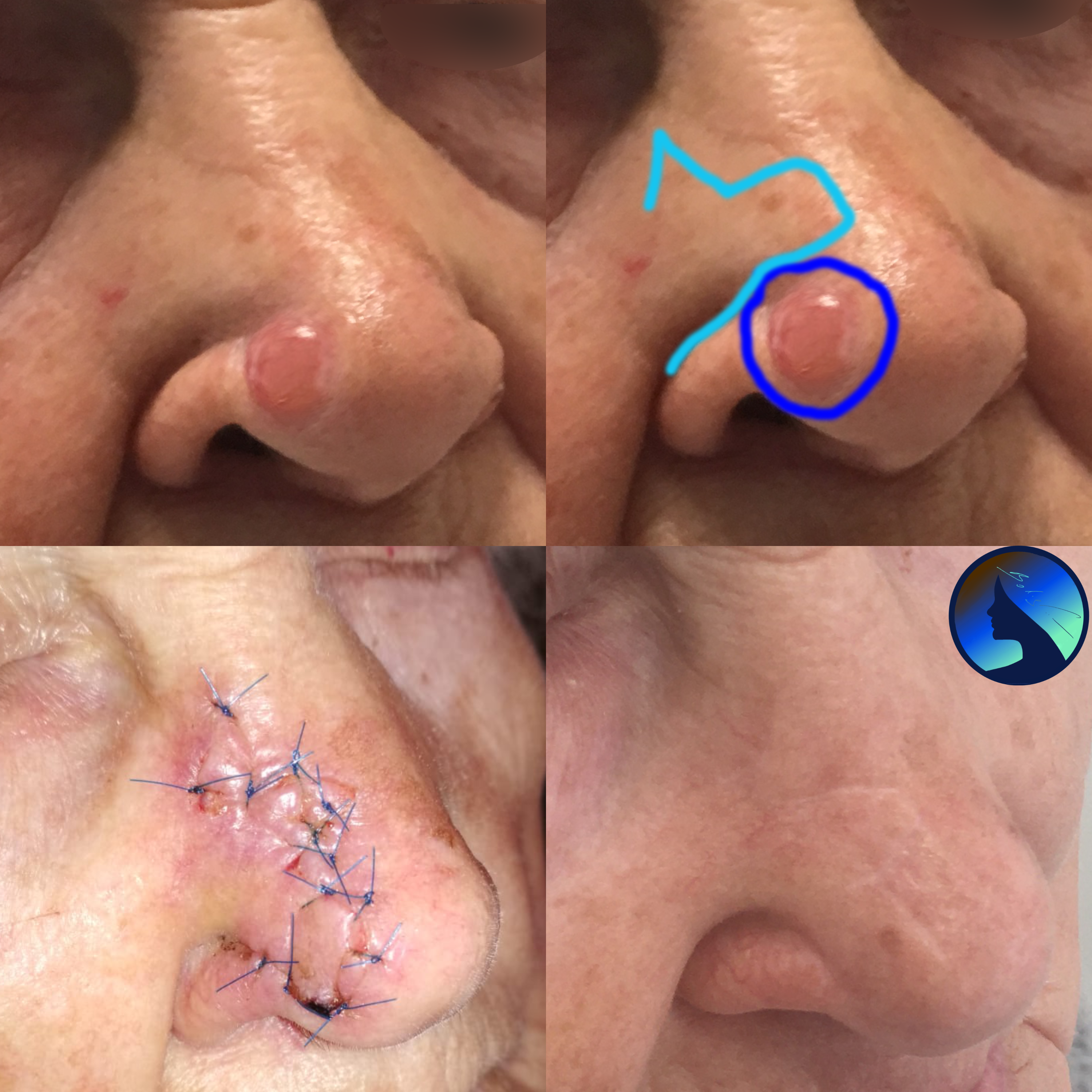Basalioma Nose 2