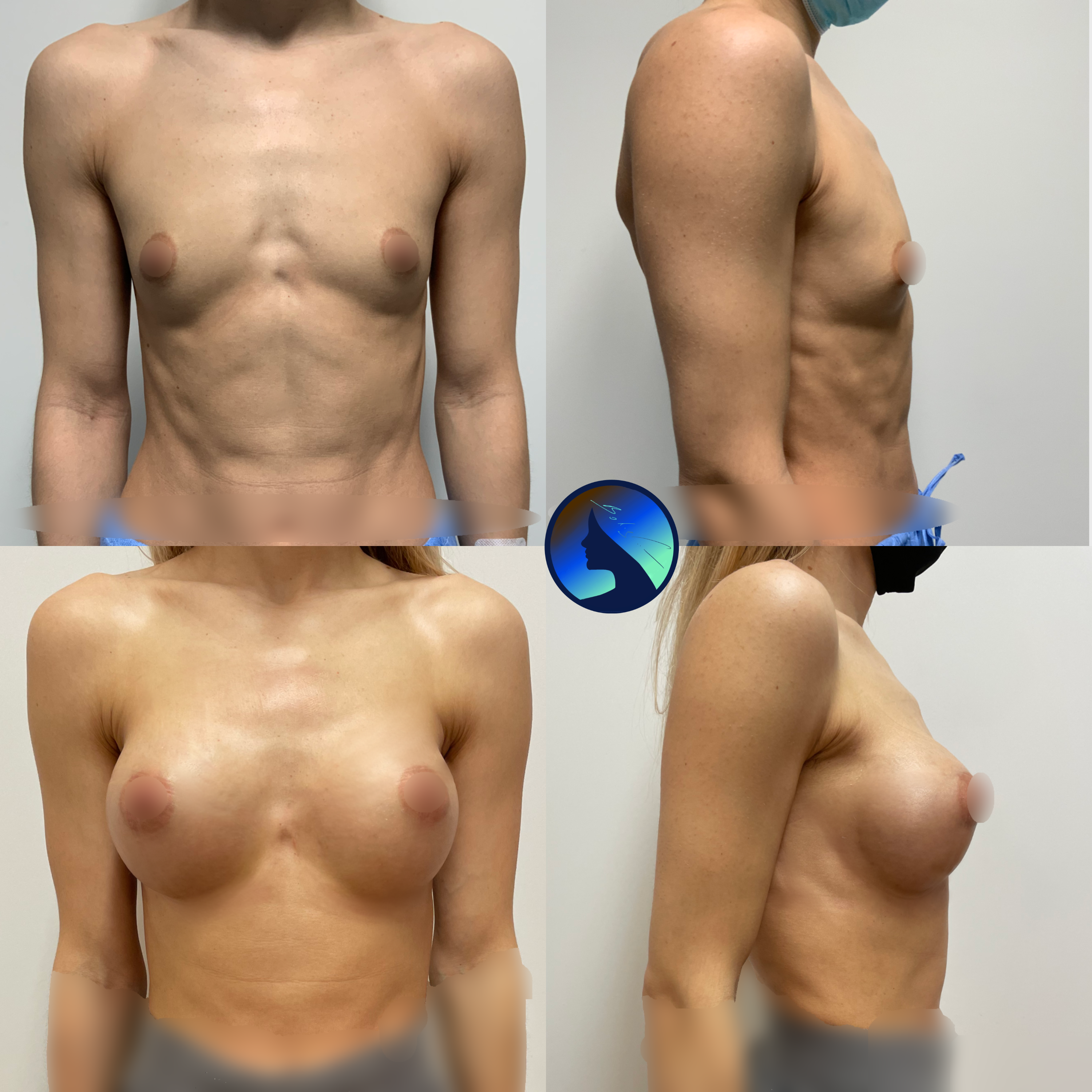 Breast implants