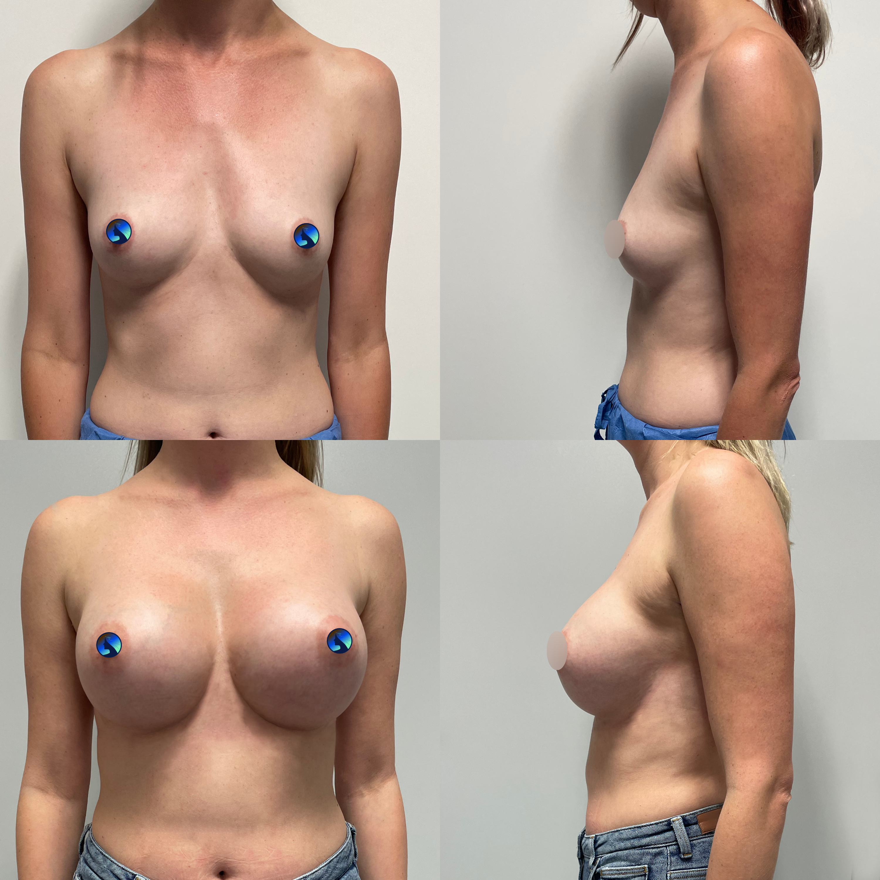Breasts full and without scar
