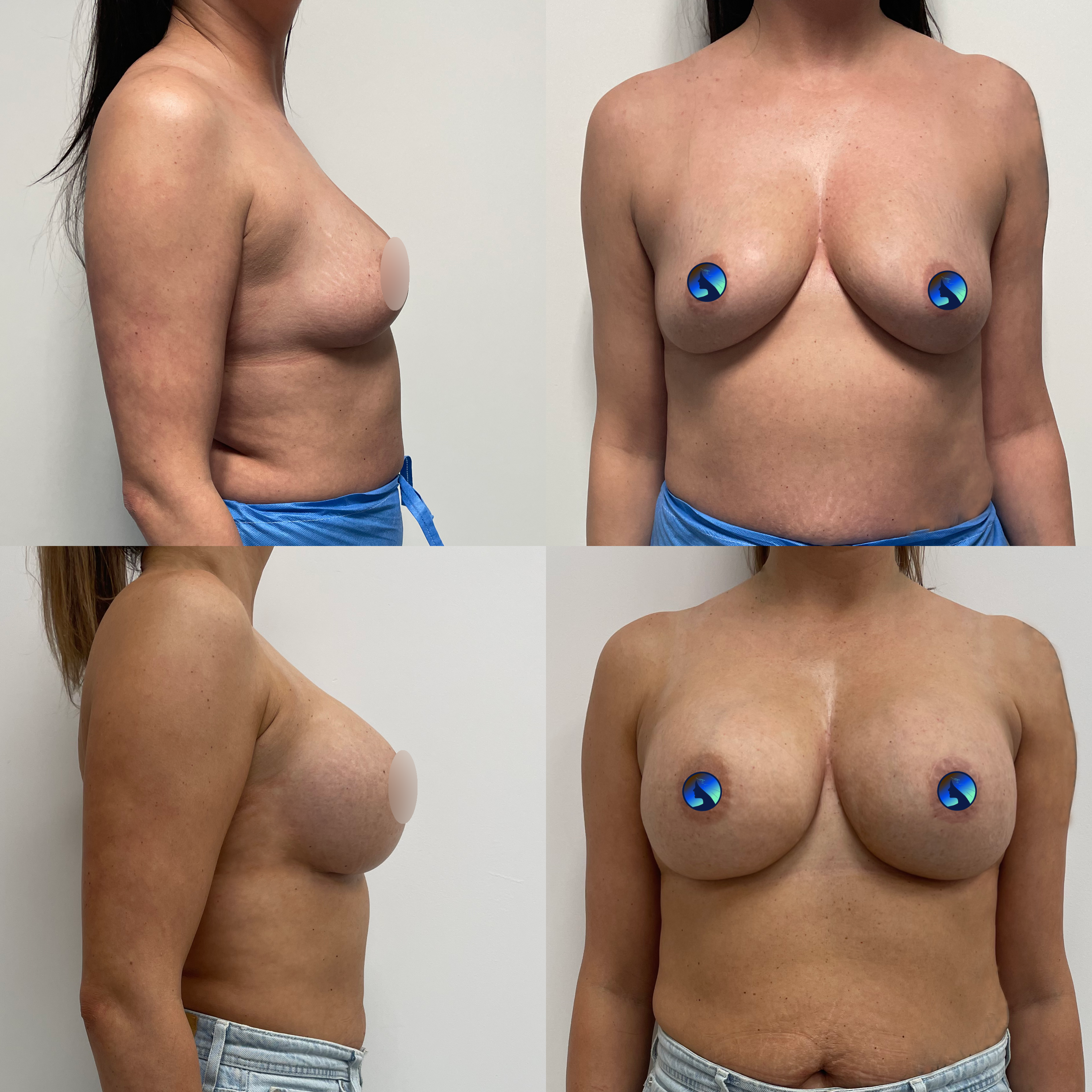 Breasts no scar