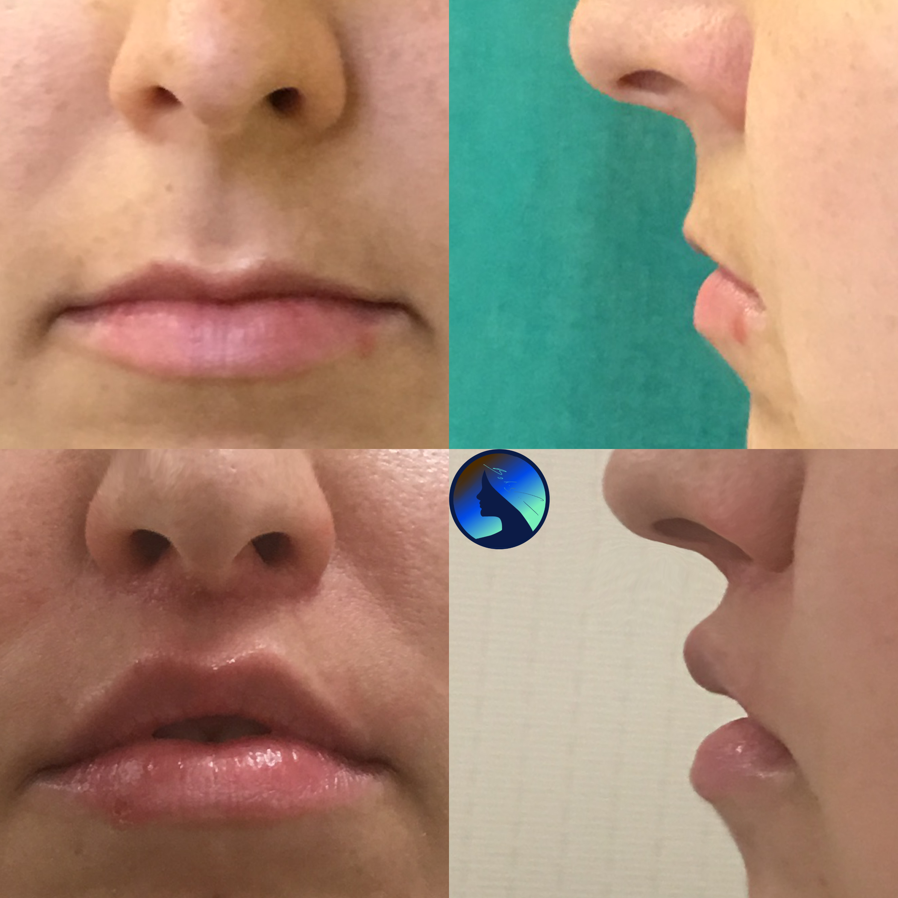 Facelift