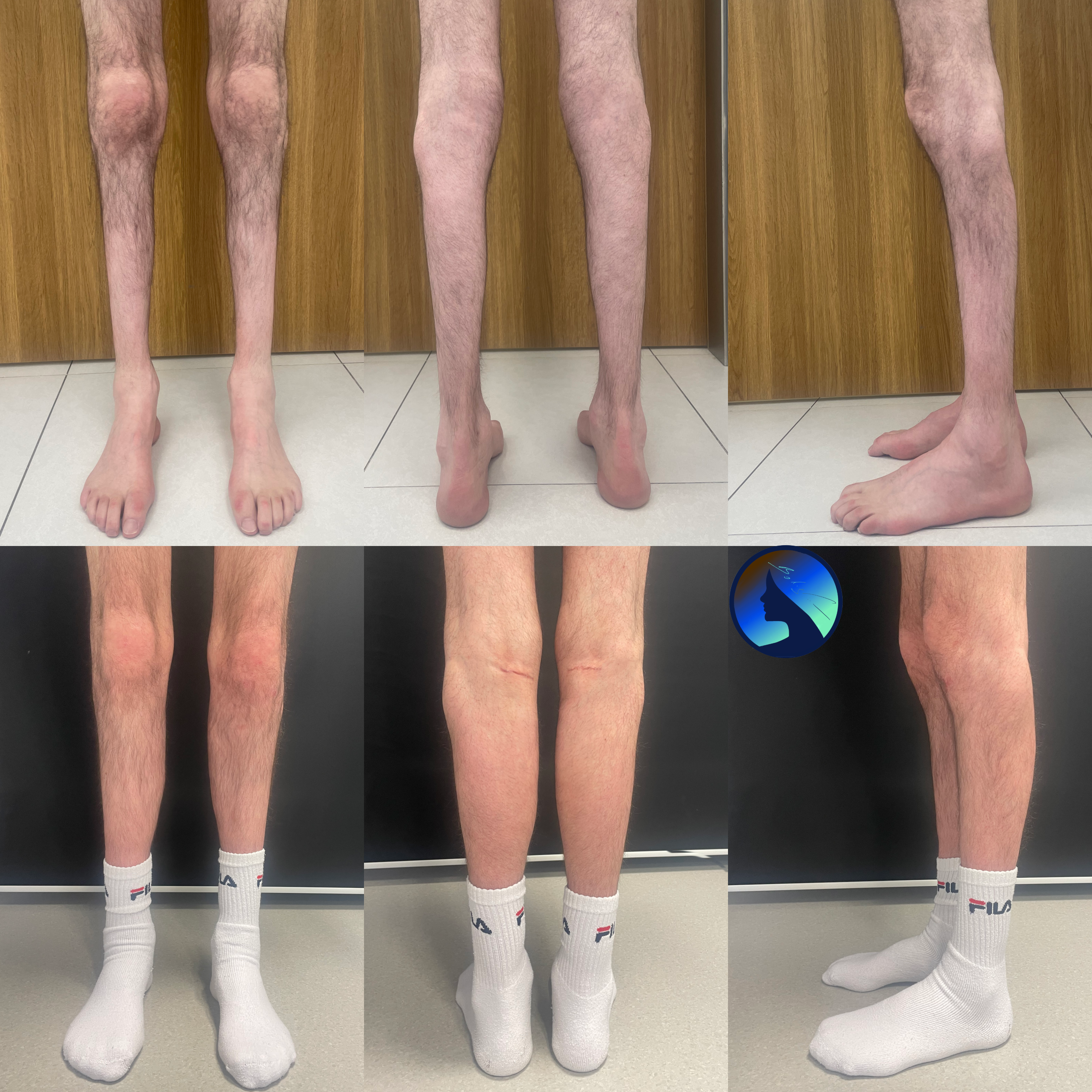 Calf Implants Calf Implants