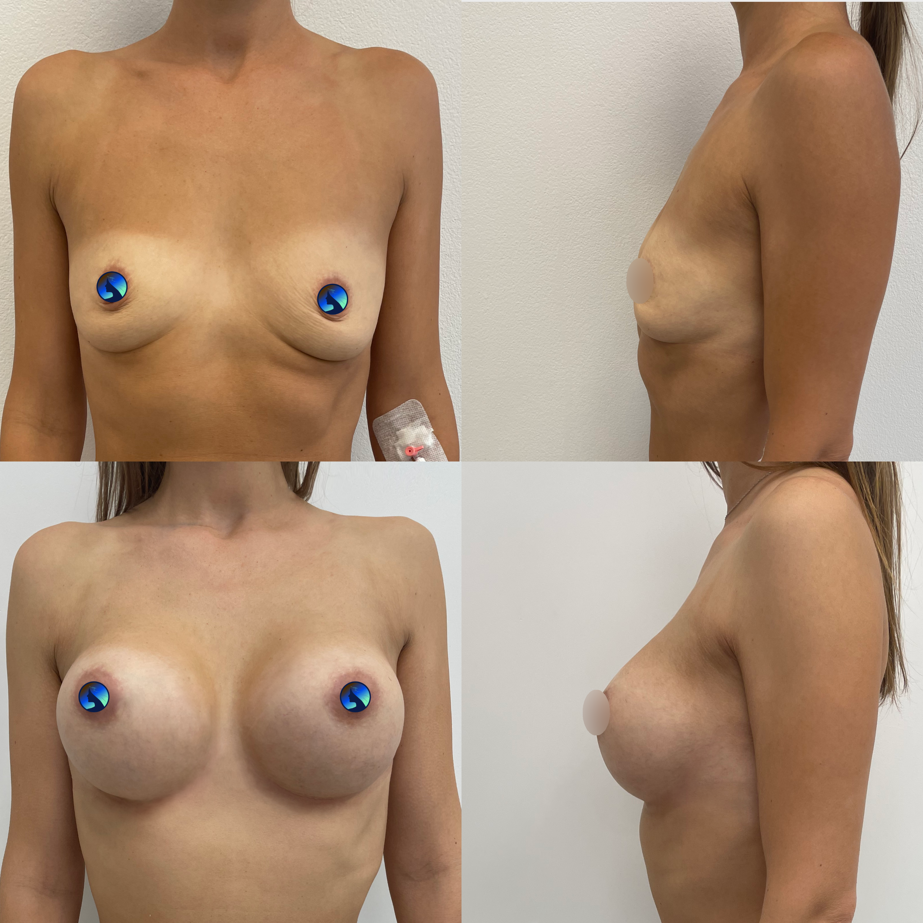 Endoscopic breast filling