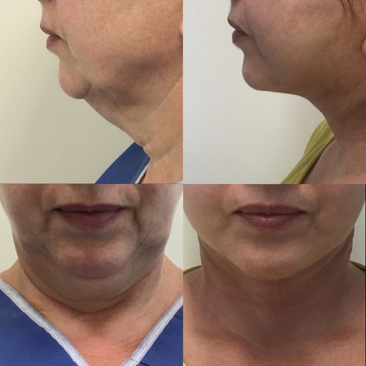 Facelift