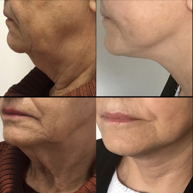 Facelift