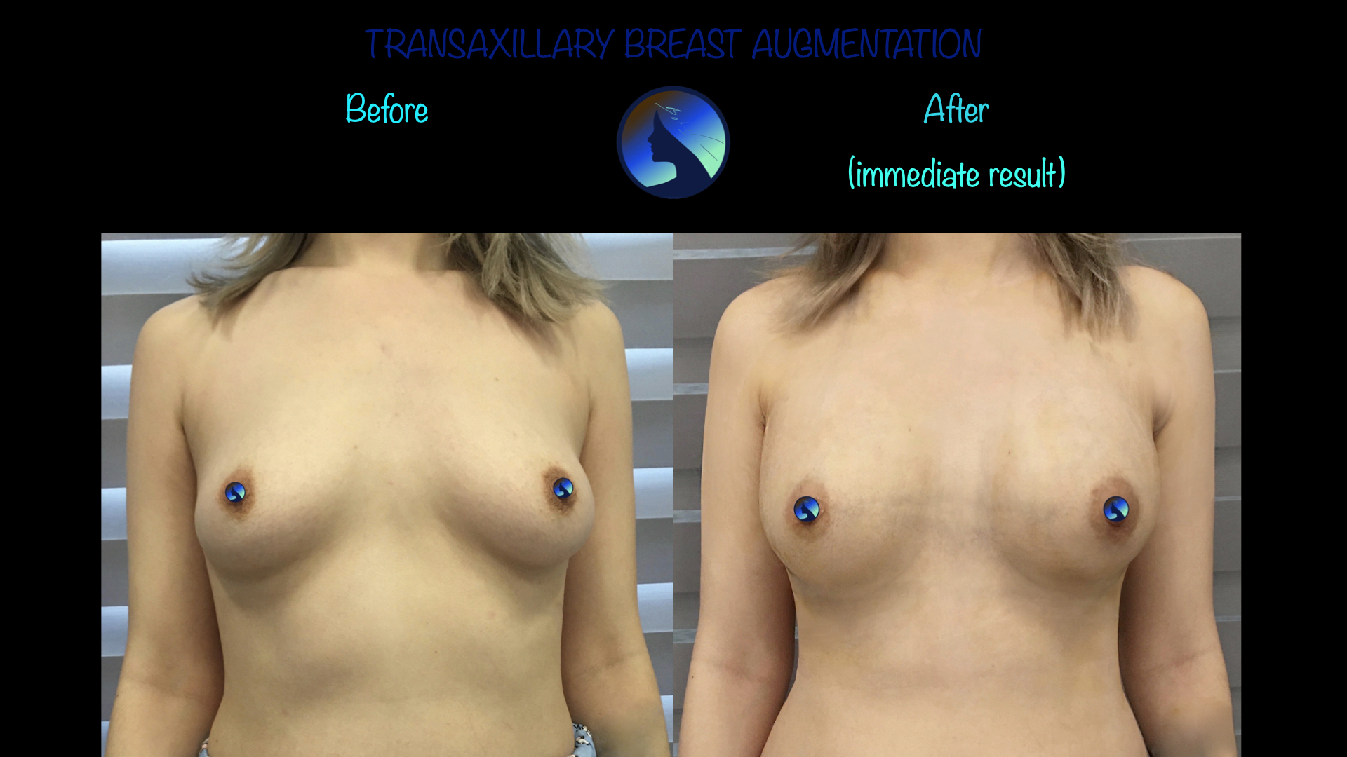 Immediate transaxillary.001