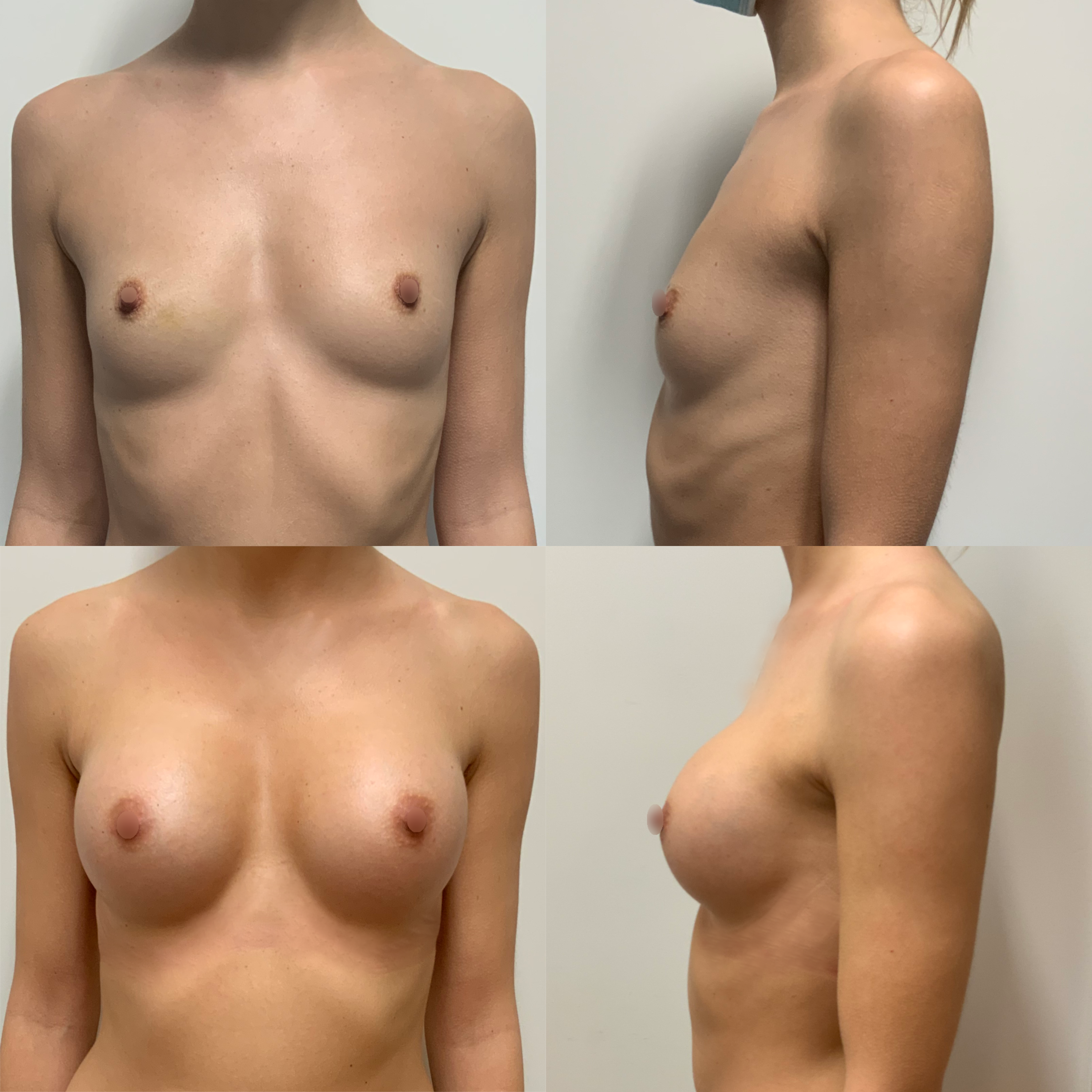 Template Breast,