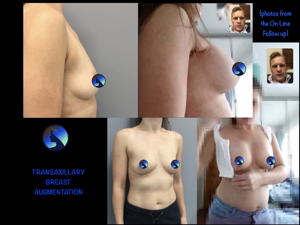 Transaxiliary