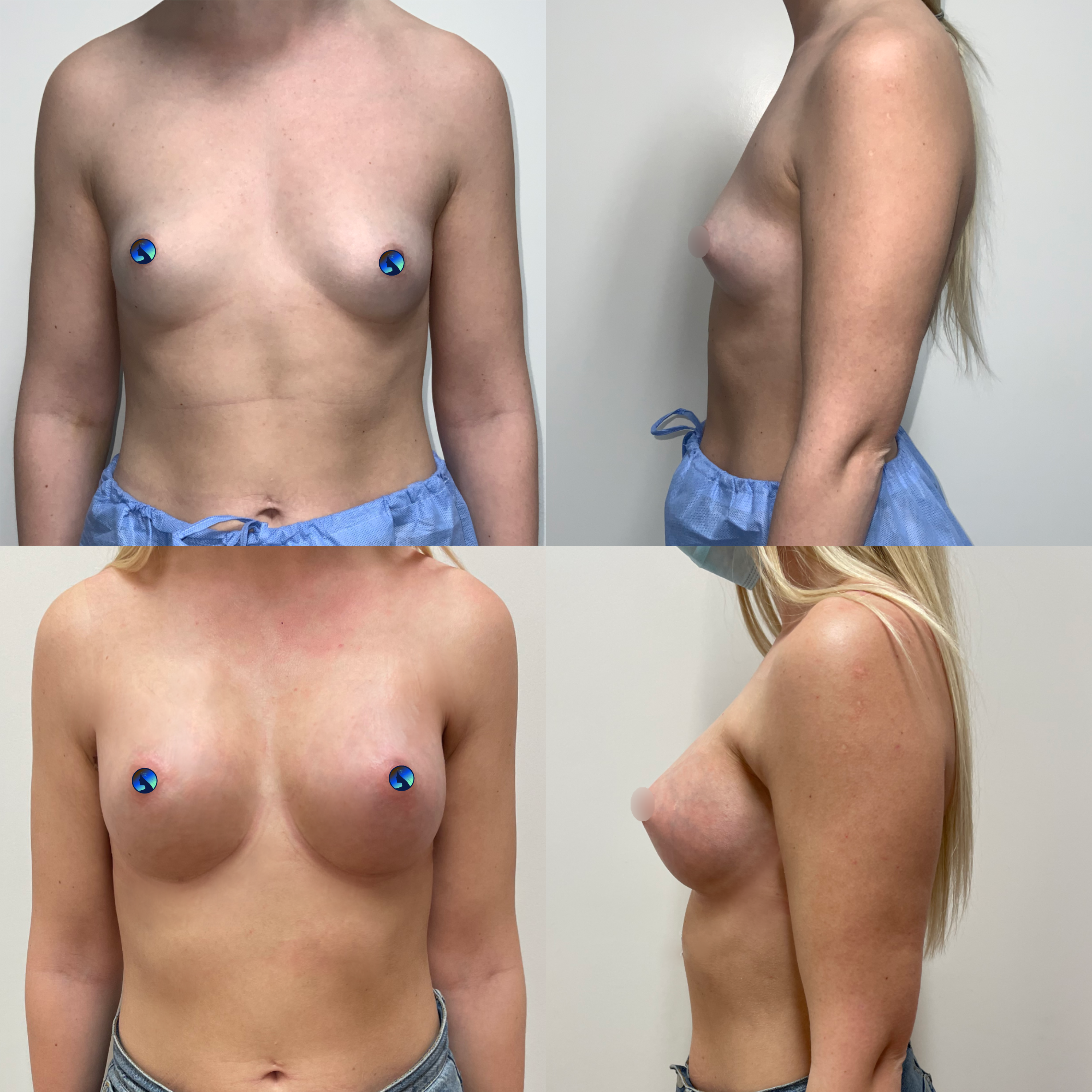 Transaxillary Breast Augmentation